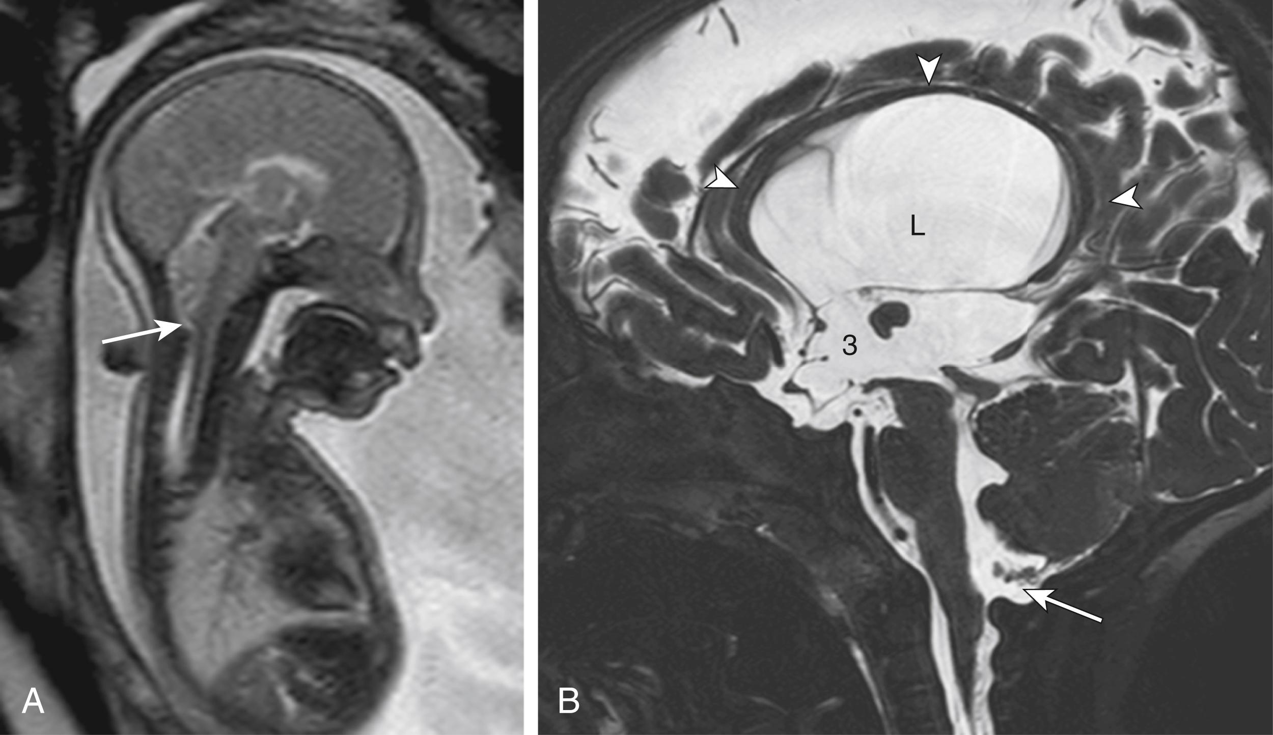 Figure 8-38, Chiari 2 myelomeningocele repair in utero.