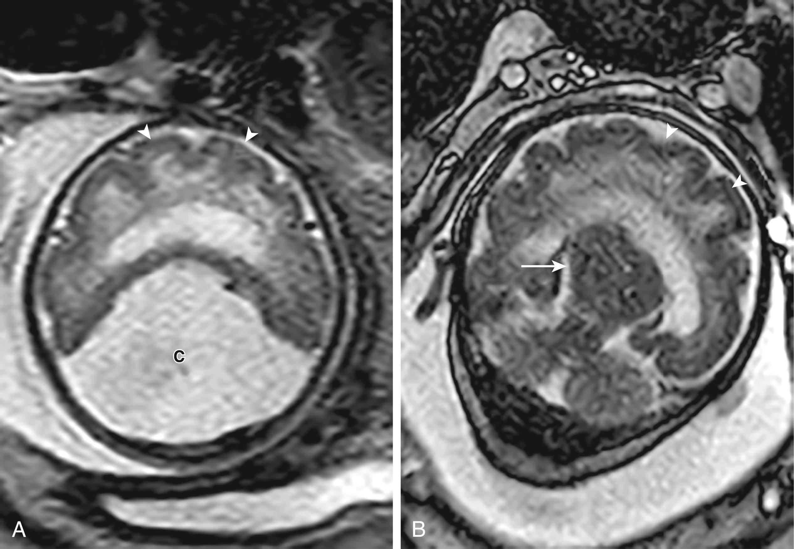 Figure 8-39, Alobar Holoprosencephaly.