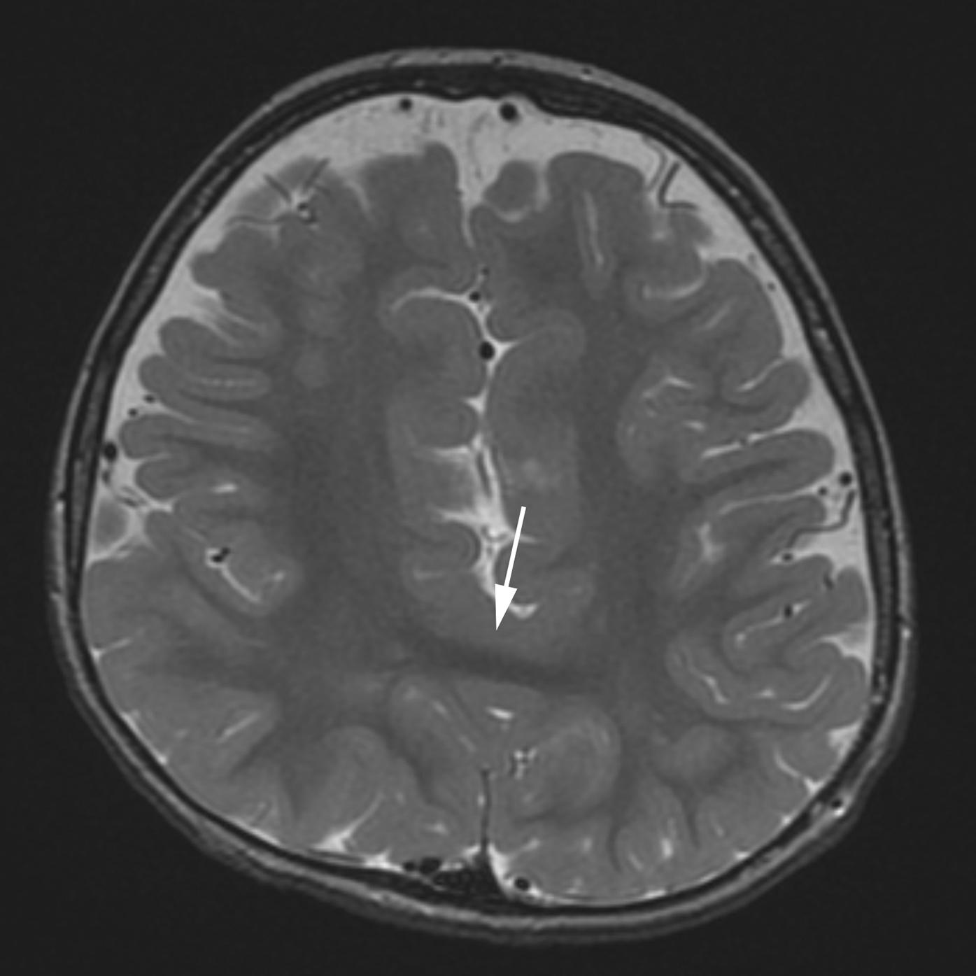 Figure 8-41, Middle interhemispheric variant of holoprosencephaly.