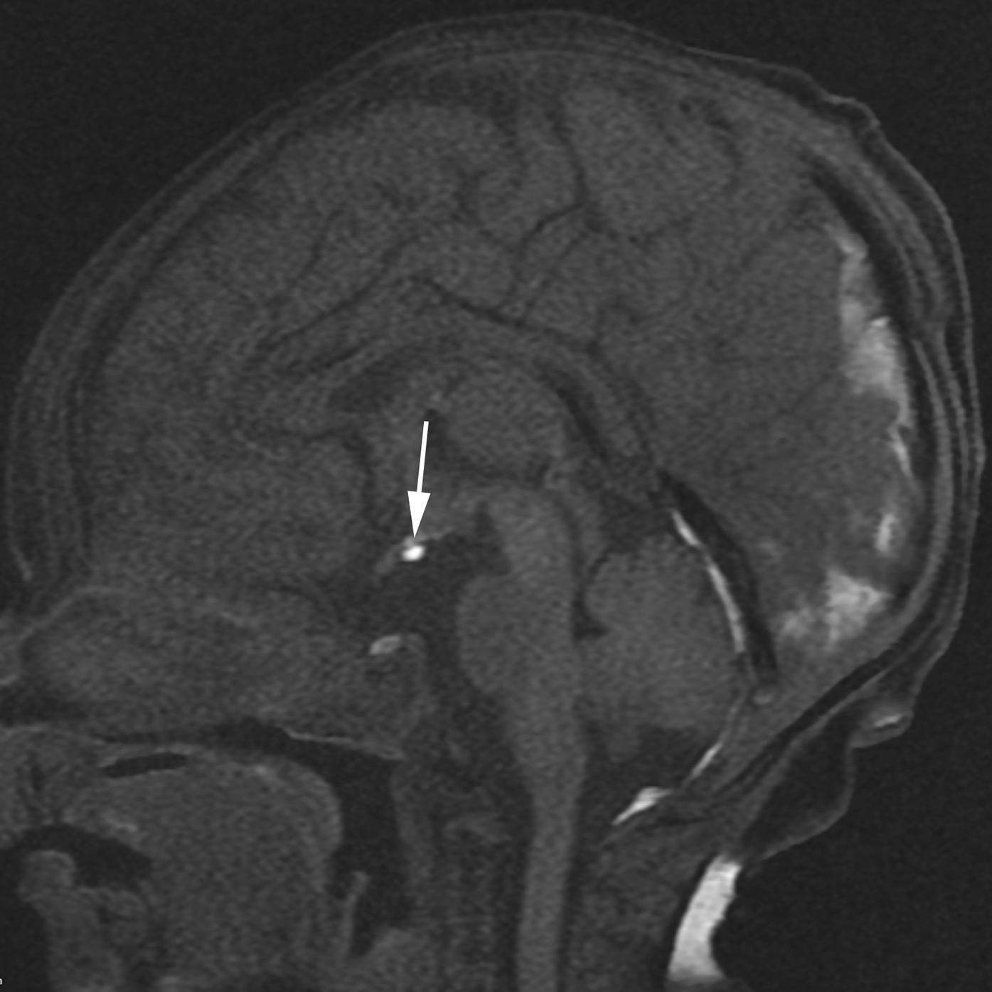 Figure 8-43, Ectopic posterior pituitary.