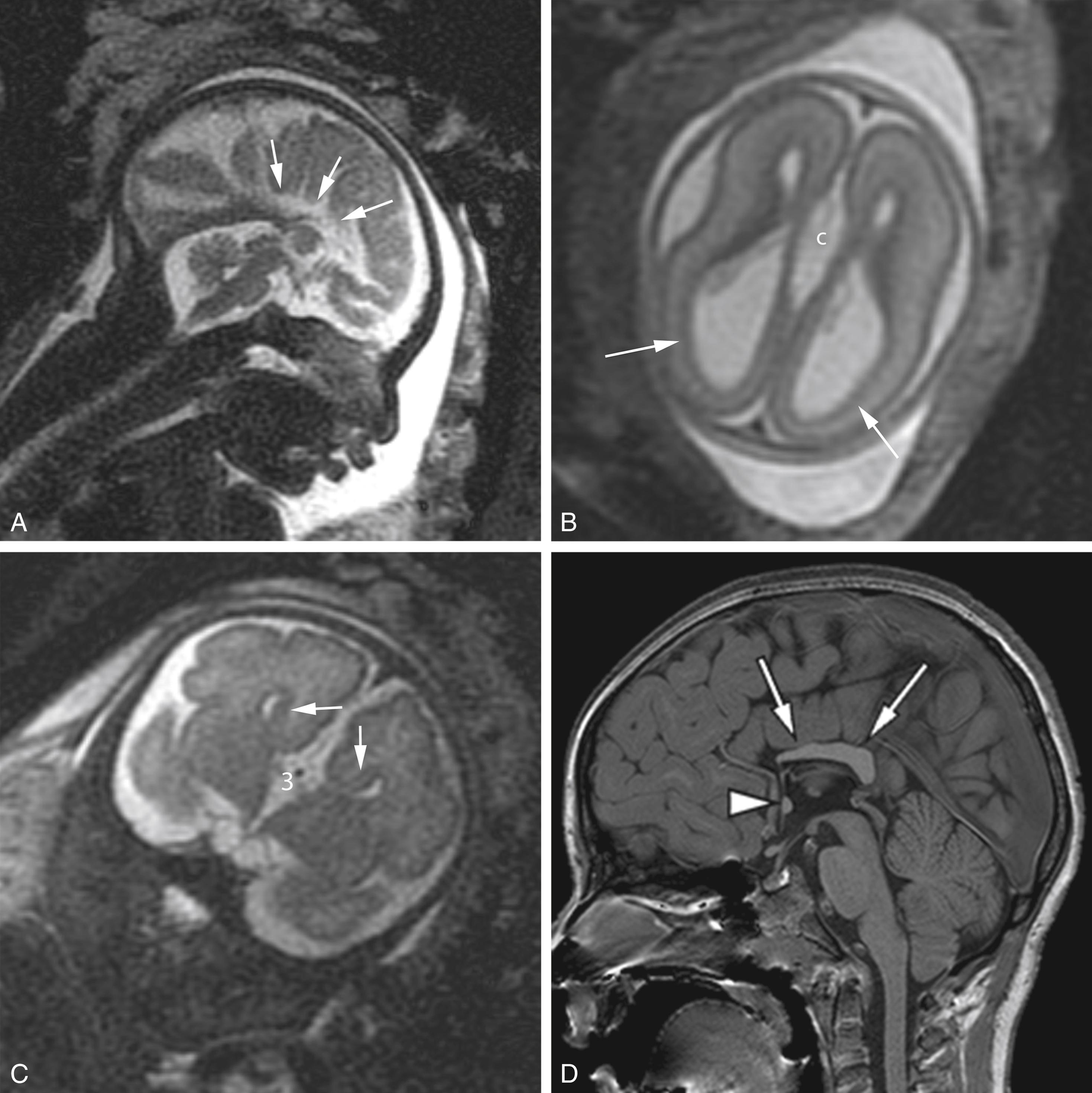 Figure 8-44, Agenesis and dysgenesis of corpus callosum in different patients.