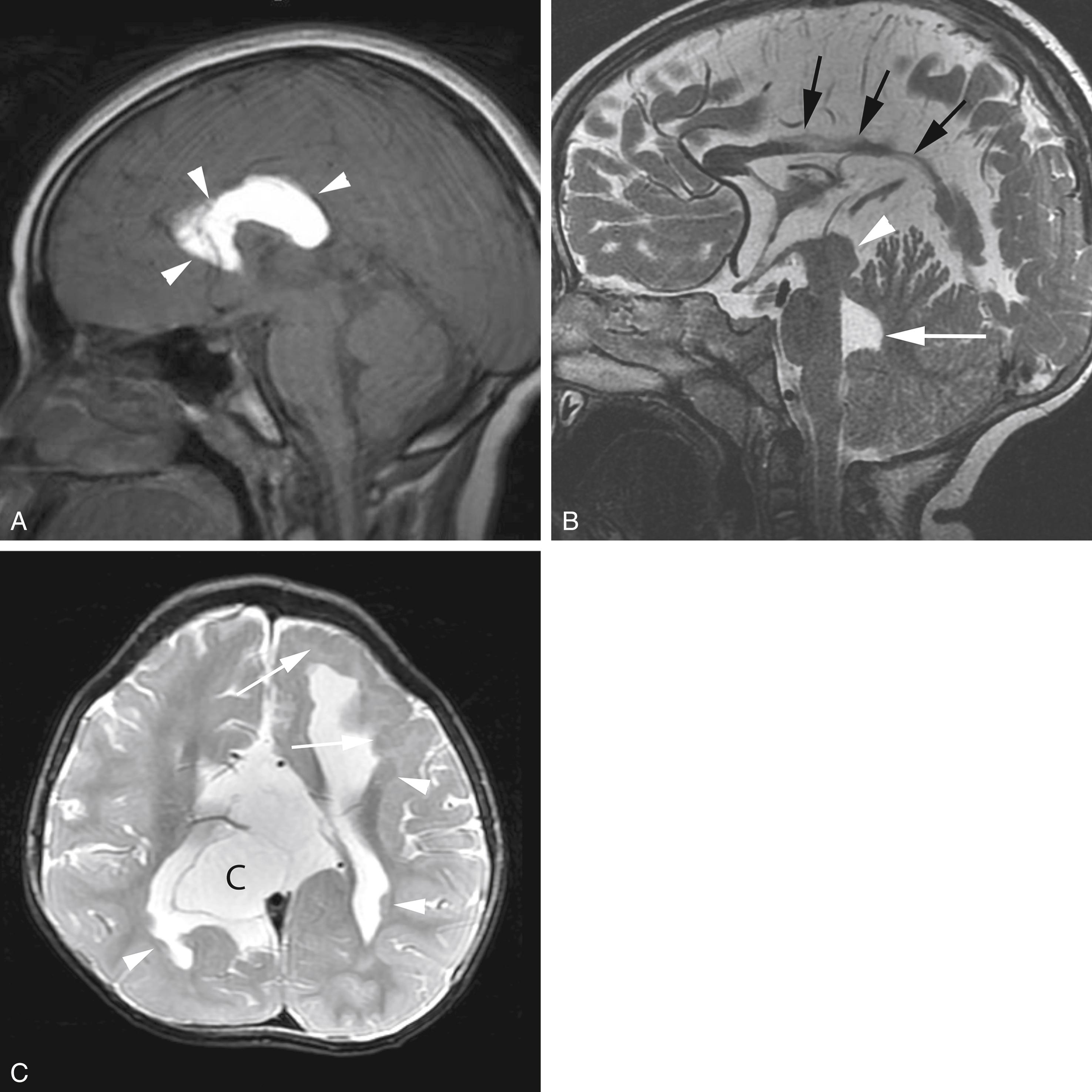 Figure 8-45, Agenesis and dysgenesis of the corpus callosum and associated congenital abnormalities.