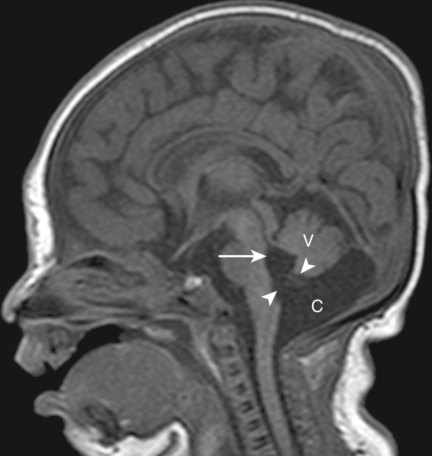 Figure 8-47, Cerebellar vermian hypoplasia.