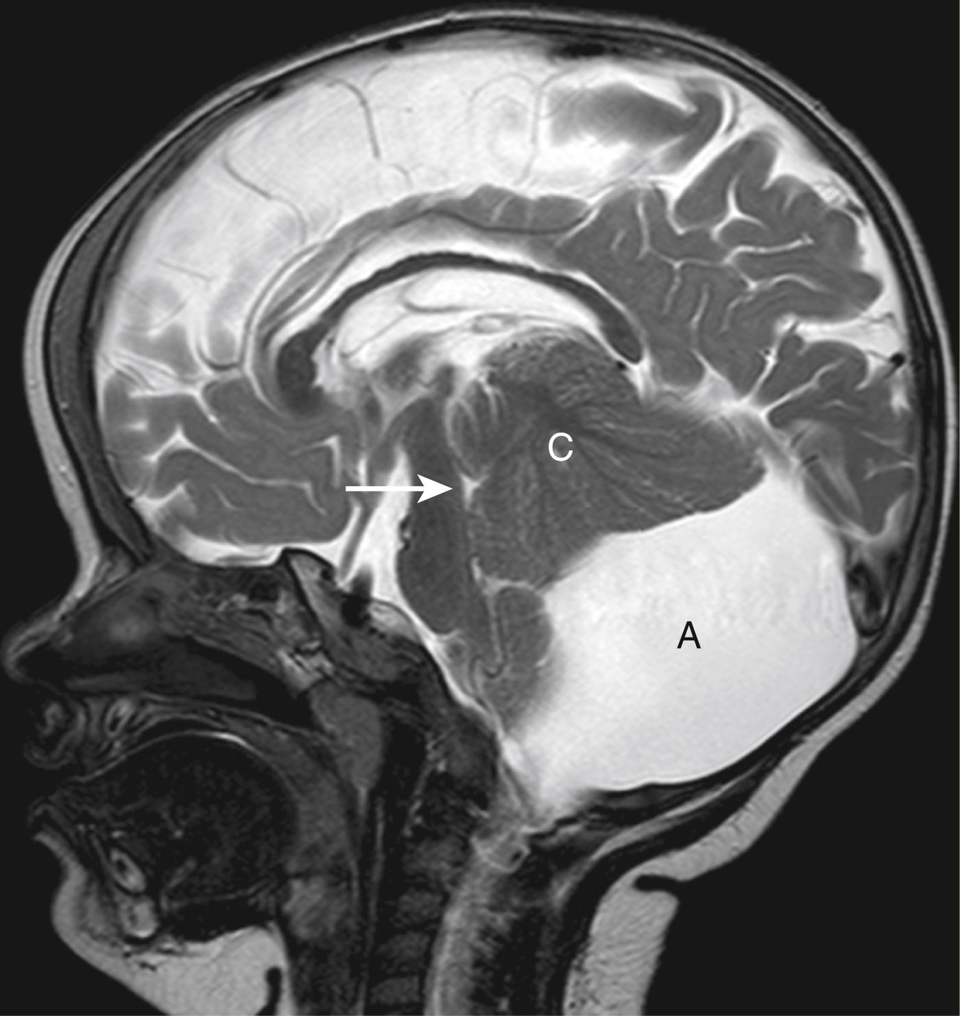 Figure 8-48, Posterior fossa arachnoid cyst.