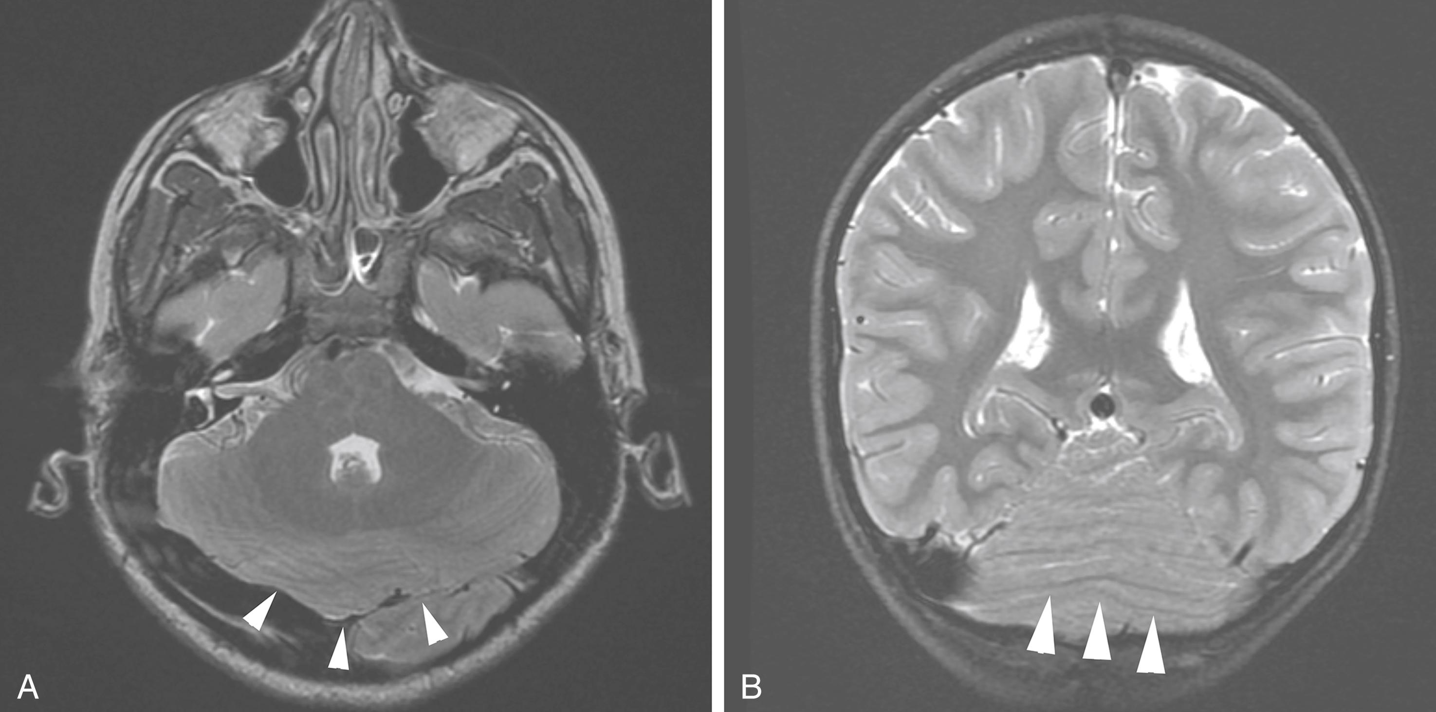 Figure 8-50, Rhombencephalosynapsis.