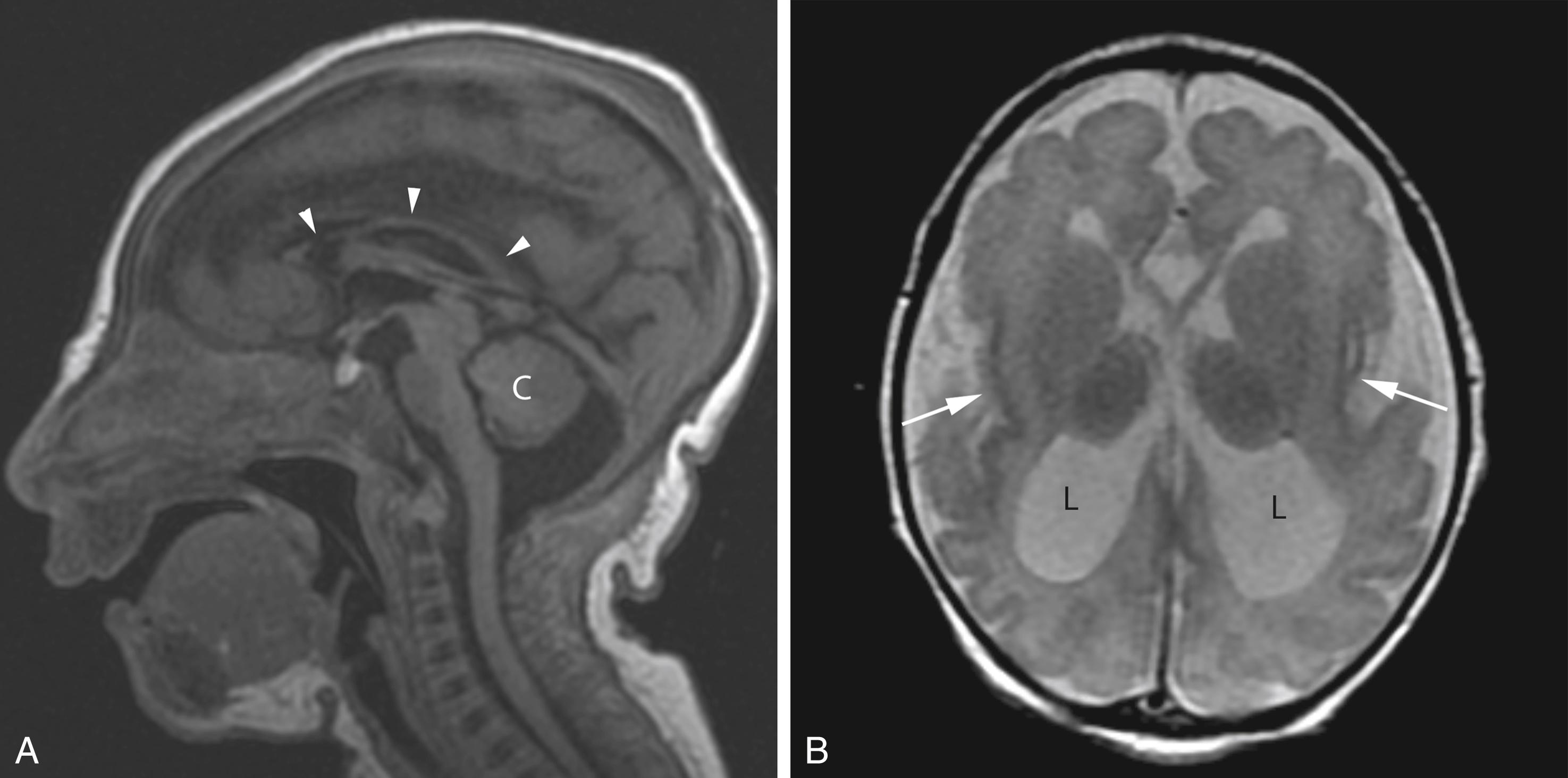 Figure 8-51, Microlissencephaly.