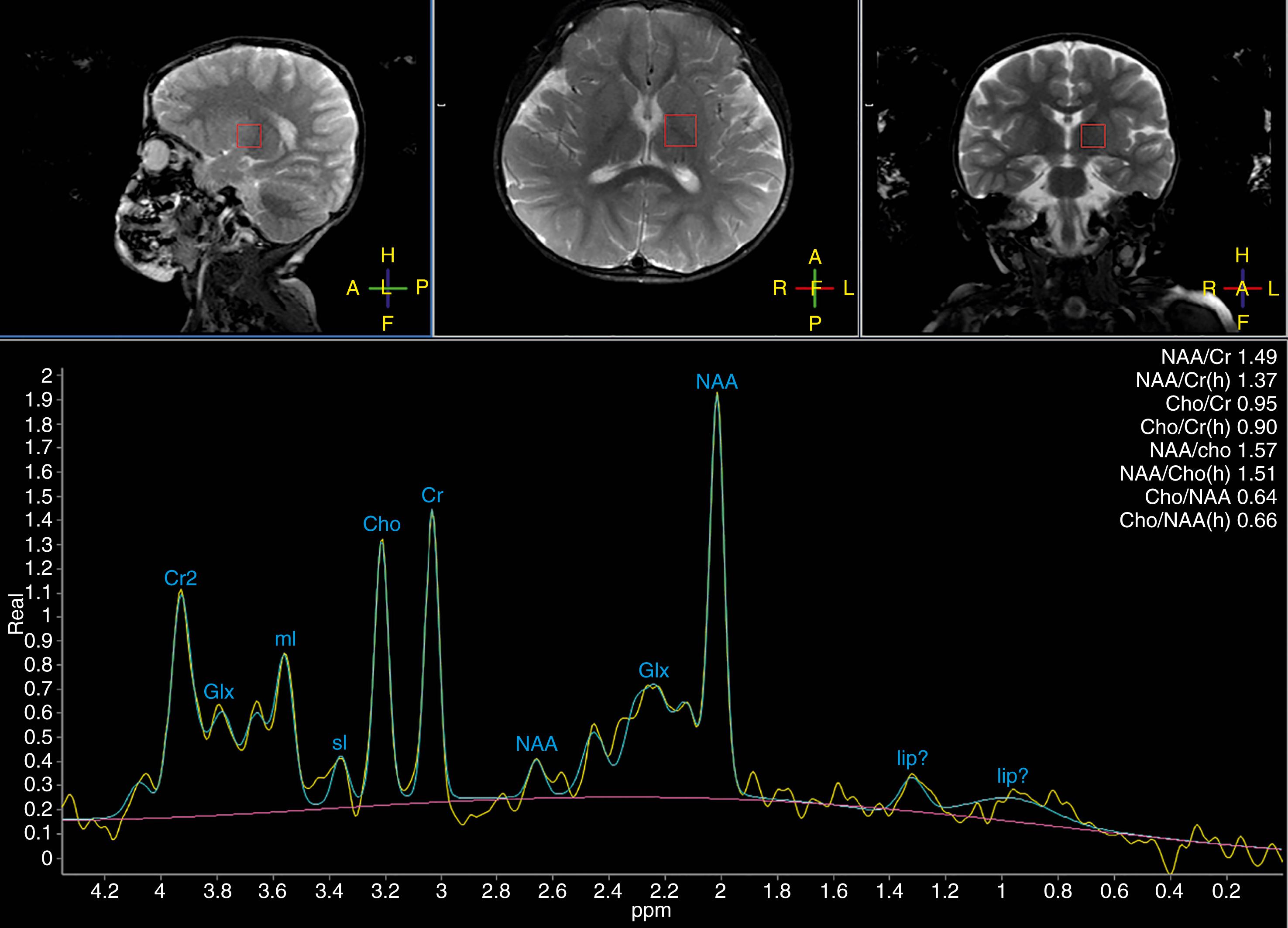 Figure 8-6, Normal short echo single voxel 1 H-MR Spectroscopy.