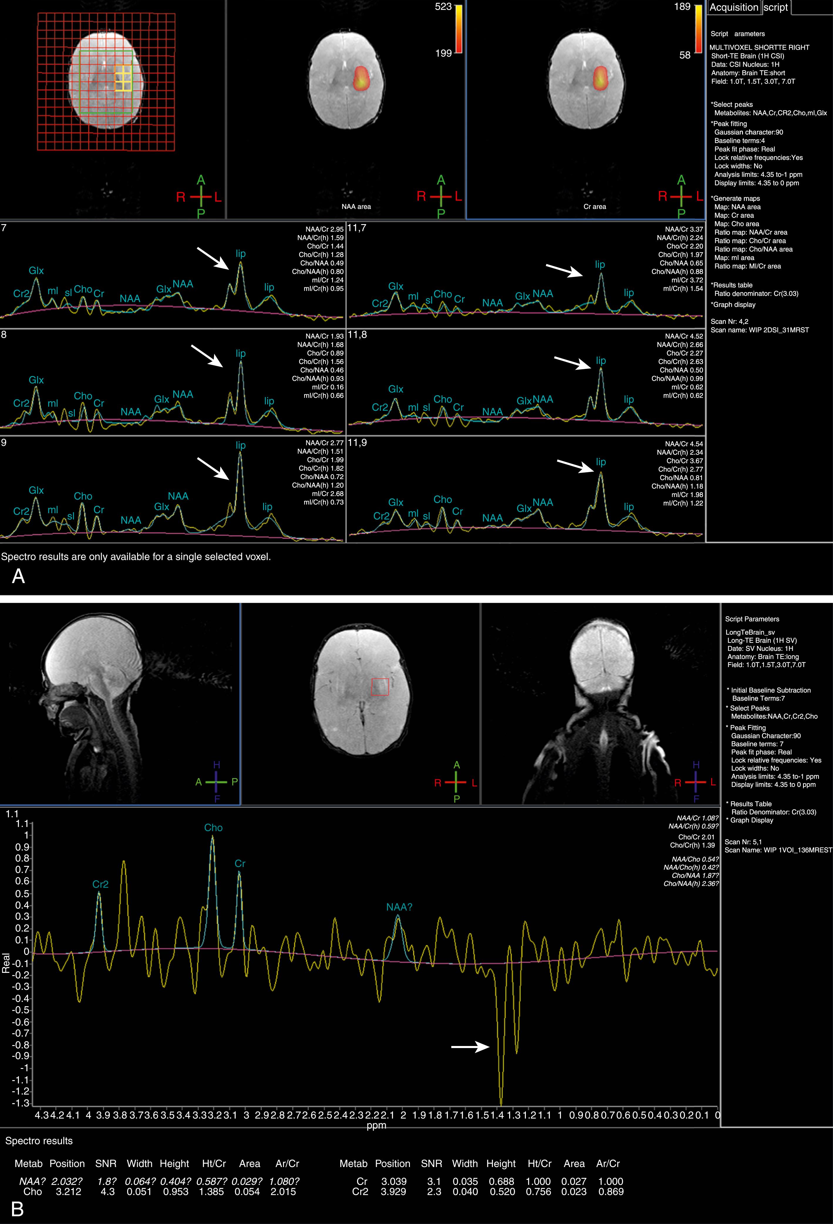 Figure 8-8, Abnormal spectroscopy in a neonate with history of hypoxic ischemic injury.