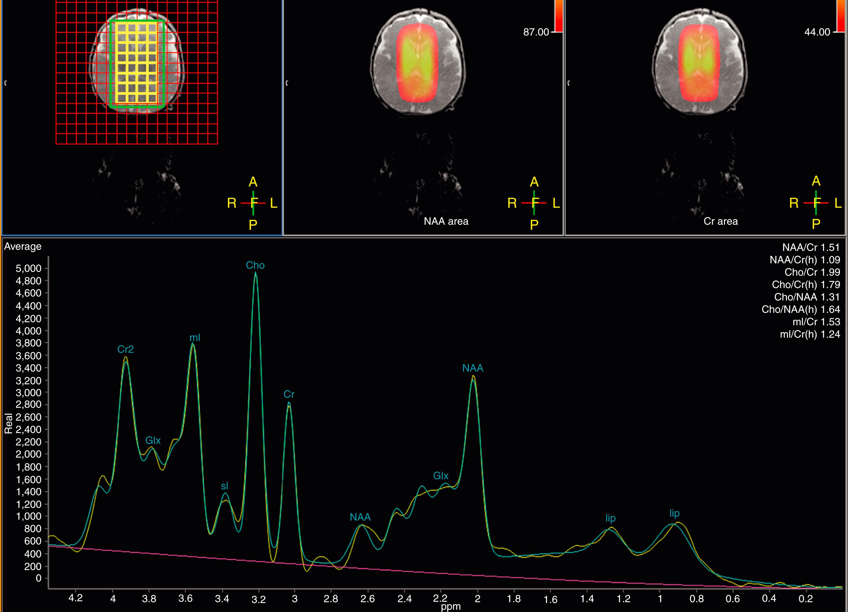 Figure 8-9, Normal neonate spectroscopy.