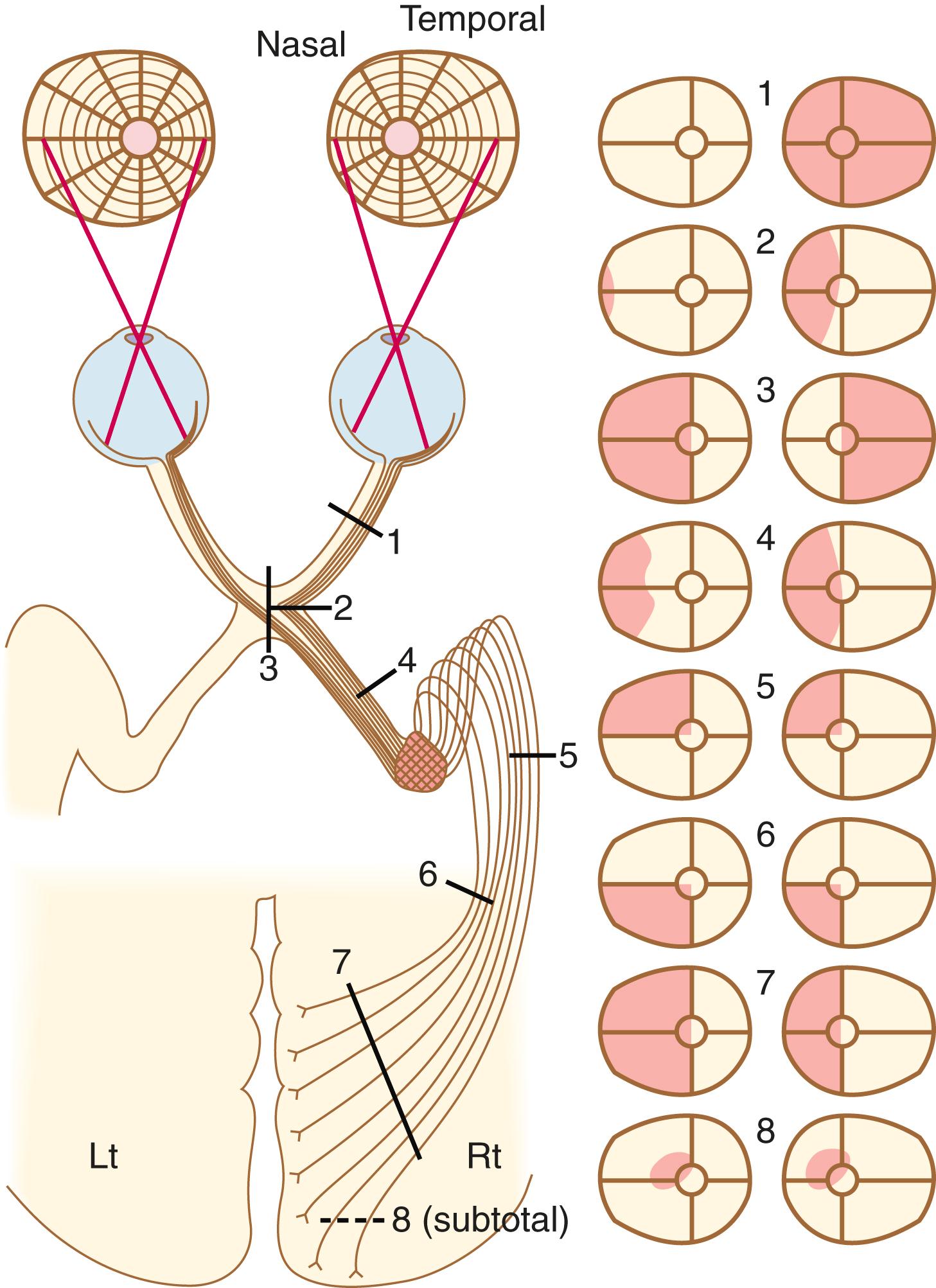 FIGURE 392-1, Visual fields that accompany damage to the visual pathways.