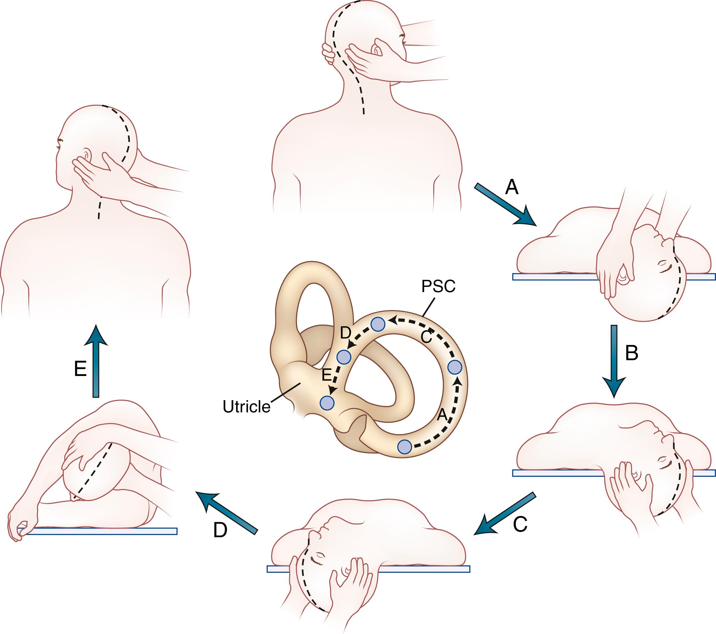Fig. 22.4, Treatment Maneuver For Benign Paroxysmal Positional Vertigo Affecting the Right Ear. Procedure can be reversed for treating the left ear. Drawing of labyrinth in the center shows position of the debris as it moves around the posterior semicircular canal (PSC) and into the utricle. A, Patient is seated upright with head facing examiner, who is standing on the right. B, Patient is then rapidly moved to head-hanging right position (Dix–Hallpike test). This position is maintained until nystagmus ceases. Examiner moves to the head of the table, repositioning hands as shown. C, Patient’s head is rotated quickly to the left, with right ear upward. This position is maintained for 30 seconds. D, Patient rolls onto the left side while examiner rapidly rotates the head leftward until the nose is directed toward the floor. This position is then held for 30 seconds. E, Patient is then rapidly lifted into the sitting position, now facing left. The entire sequence should be repeated until no nystagmus can be elicited. Following the maneuver, the patient is instructed to avoid head-hanging positions to prevent the debris from re-entering the posterior canal.