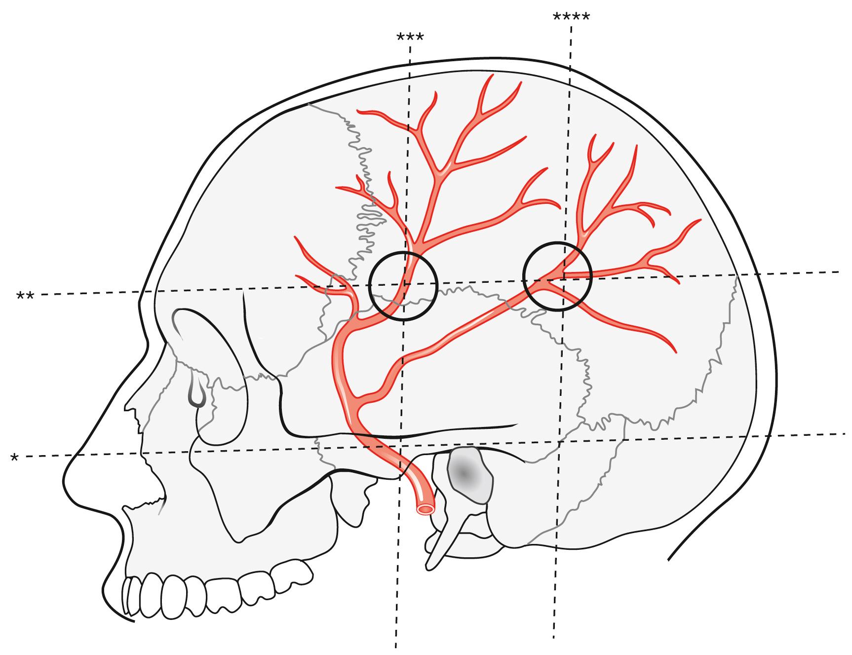 Fig. 12.6, Circles mark the projections of the main frontal and parietal branches of the middle meningeal artery onto the side of the skull.