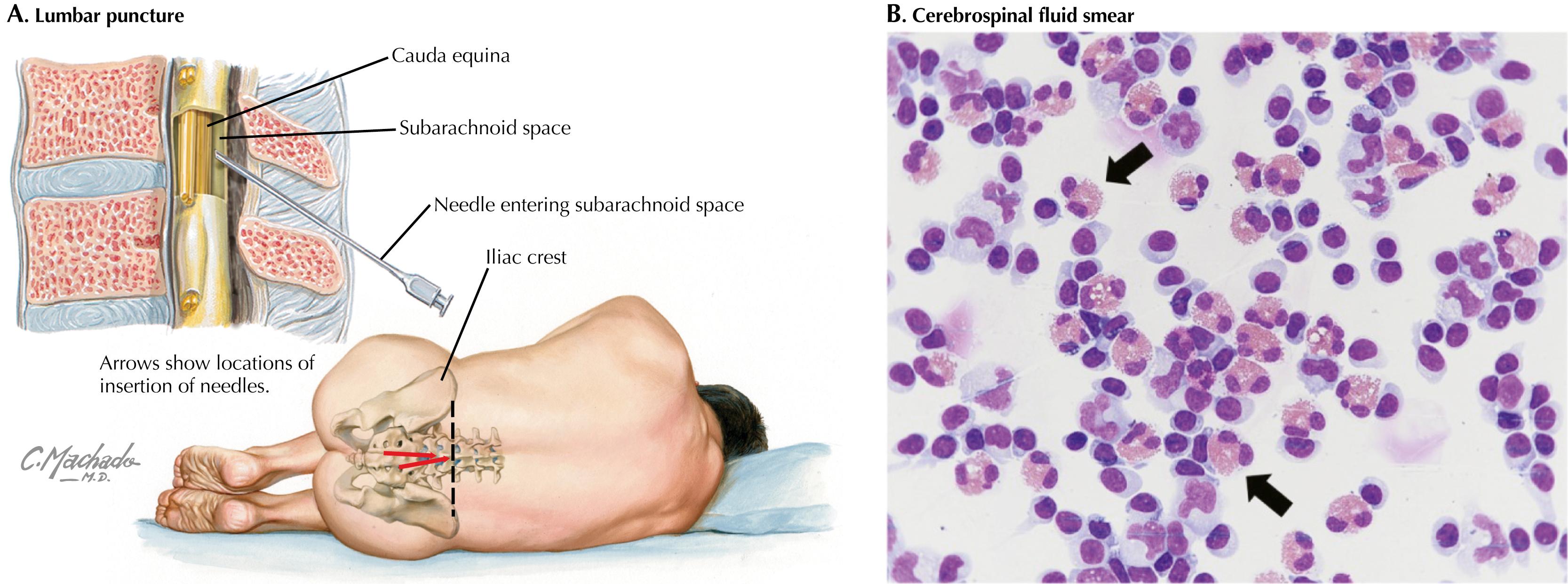 Fig. 93.3, (A) Lumbar puncture with manometry to record the opening pressure. (B) Stained cerebrospinal fluid smear showing eosinophils in a patient with eosinophilic meningitis due to Angiostrongylus cantonensis. Black arrows indicate eosinophilic granulocytes with mostly bilobed, occasionally trilobed nuclei and normal eosinophilic granulation.