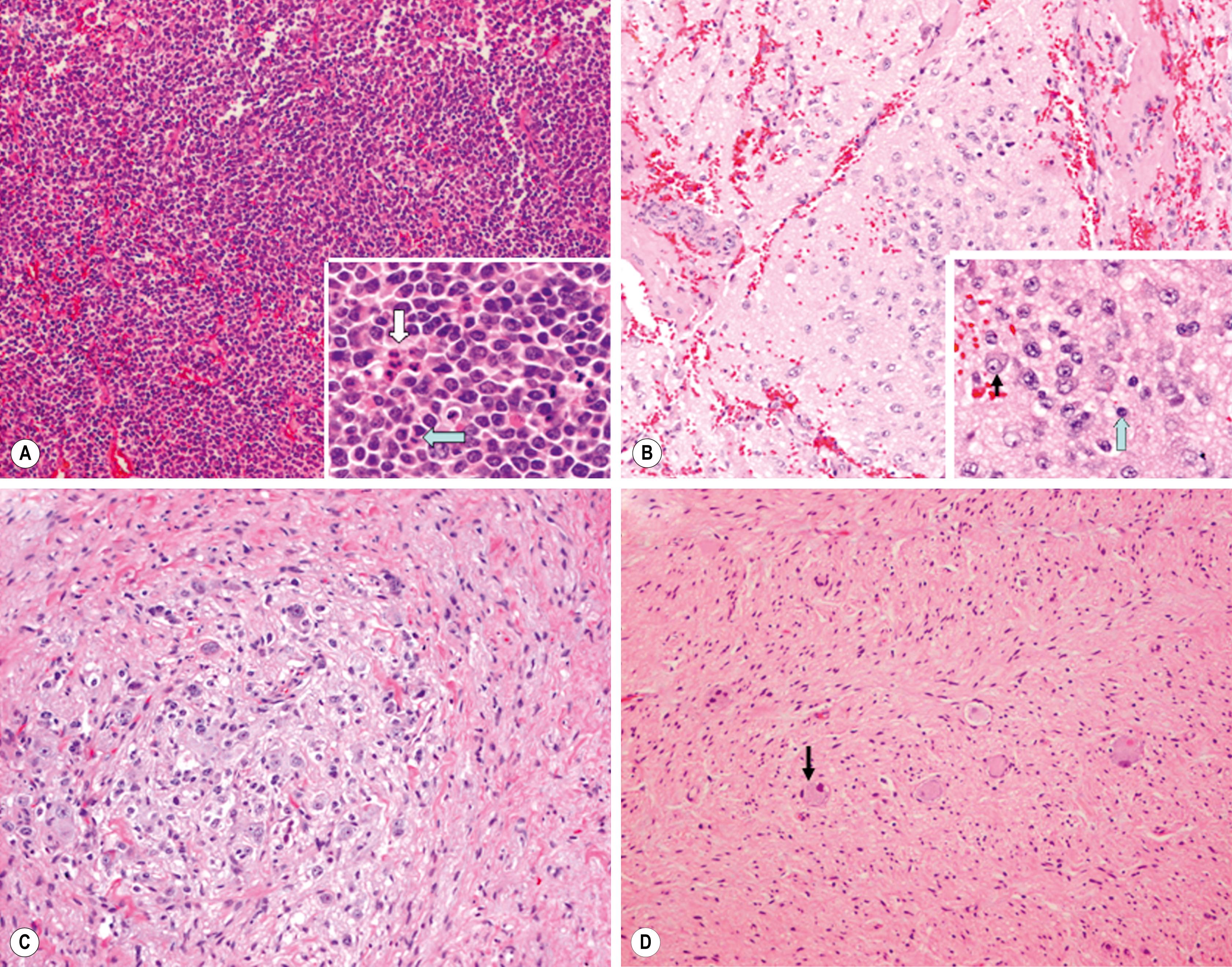 Fig. 65.1, Histologic appearance of neuroblastic tumors. (A) An undifferentiated neuroblastoma with high MKI (10×). A clump of karyorrhectic tumor cells (white arrow) and a tumor cell undergoing mitosis (gray arrow) are shown in the insert (60×). (B) A differentiating neuroblastoma, with low MKI (10×). A primitive neuroblast (gray arrow) and a differentiating tumor cell (black arrow), with features of differentiation in both the nucleus and cytoplasm, are shown in the insert (60×). Abundant neuropil is also seen. (C) A stroma-rich ganglioneuroblastoma with infrequent neuroblasts intermixed within abundant Schwannian stroma and ganglion cells (10×). (D) A stroma-rich ganglioneuroma. Ganglion cells are seen (arrow) (10×). Infiltrating lymphoid cells are also seen, but no neuroblasts are present.