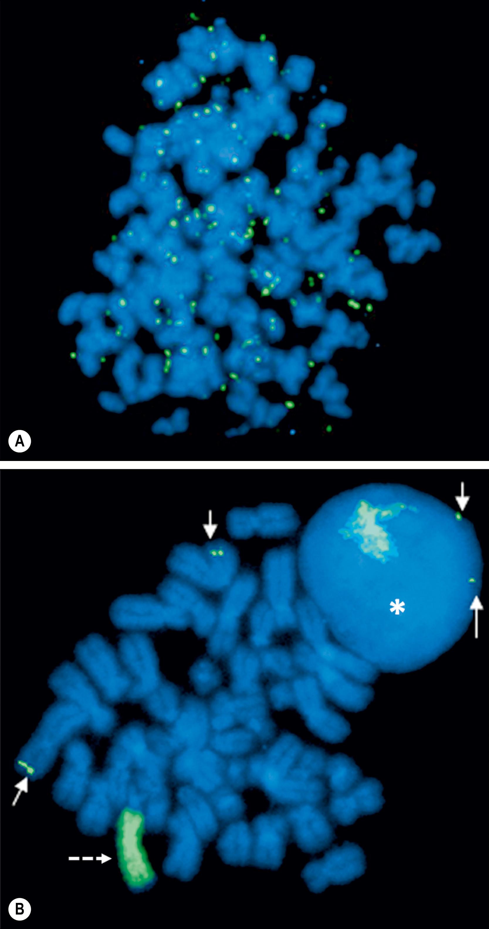 Fig. 65.2, FISH analysis of a neuroblastoma. (A) Chromosomes in metaphase. The bright spots are double-minute chromatin bodies. (B) The metaphase chromosomes are again seen. An intact interphase nucleus is marked with an asterisk. The normal two copies of the MYCN gene are marked with solid arrows. Homogeneously staining regions (HSRs) are also seen. One is seen in the interphase nucleus, and the other is marked with a dotted arrow.