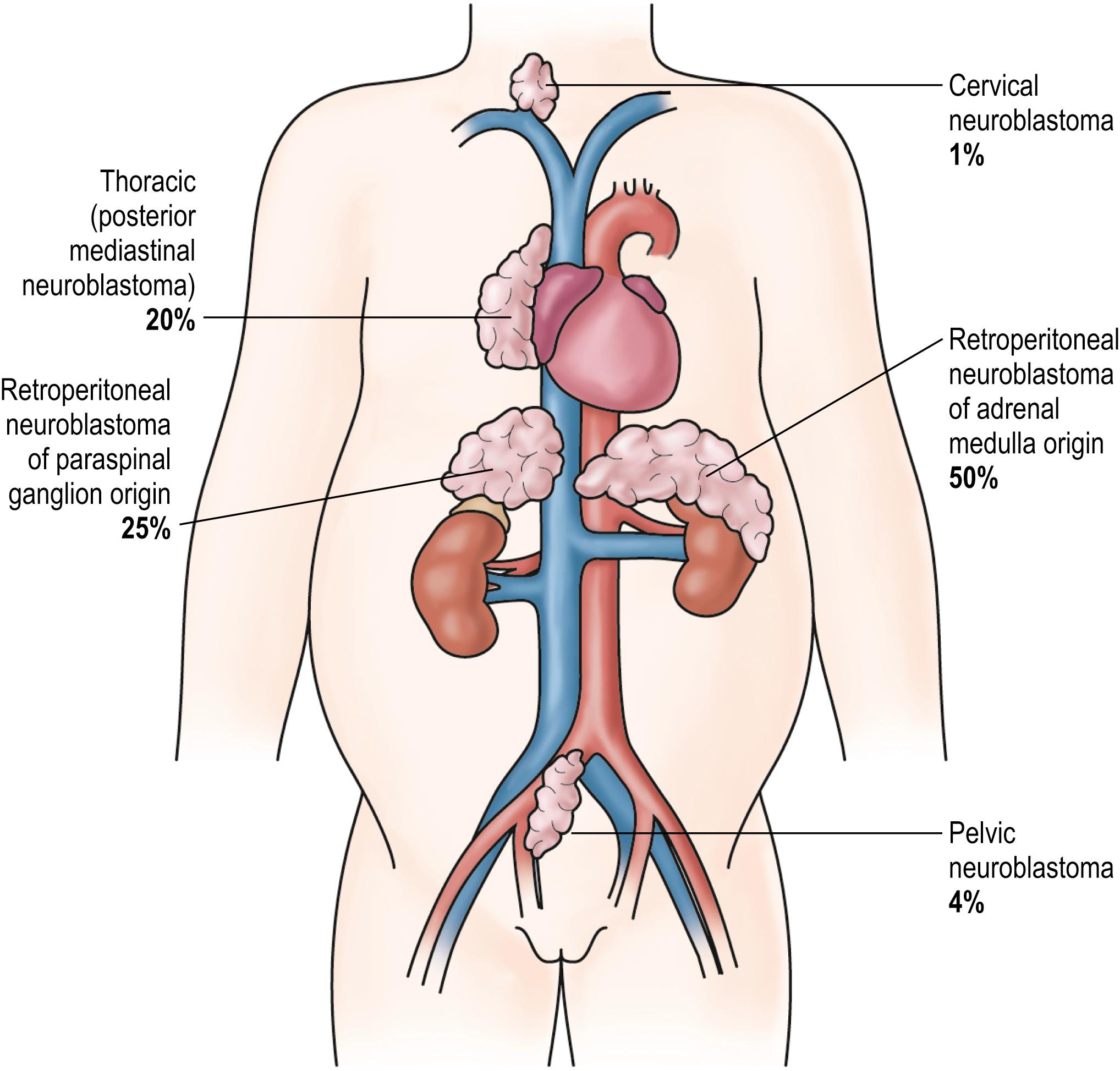 Fig. 65.3, Primary sites for neuroblastoma are depicted in this anatomic drawing.