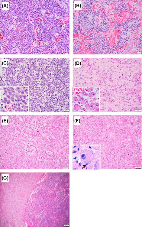 Figure 1.1, Categories and Subtypes of Peripheral Neuroblastic Tumors: (A) Neuroblastoma, Undifferentiated subtype (NB-UD); (B) Neuroblastoma, Poorly differentiated subtype (NB-PD); (C) MYCN amplified tumor showing the appearance of NB-PD with a high MKI (Mitosis-Karyorrhexis Index), (inset: neuroblastic cells having prominent nucleolar formation); (D) Neuroblastoma, Differentiating subtype (NB-D) (inset: typical differentiating neuroblasts with both cytoplasmic and nuclear enlargement); (E) Ganglioneuroblastoma, Intermixed (GNB-I); (F) Ganglioneuroma (GN) [inset: completely mature ganglion cell covered with satellite cell ( arrow )]; (G) Ganglioneuroblastoma, Nodular (GNB-N) composed of two distinct histologies (clones)—Ganglioneurmatous tissue (left) and neuroblastomatous nodule (right).