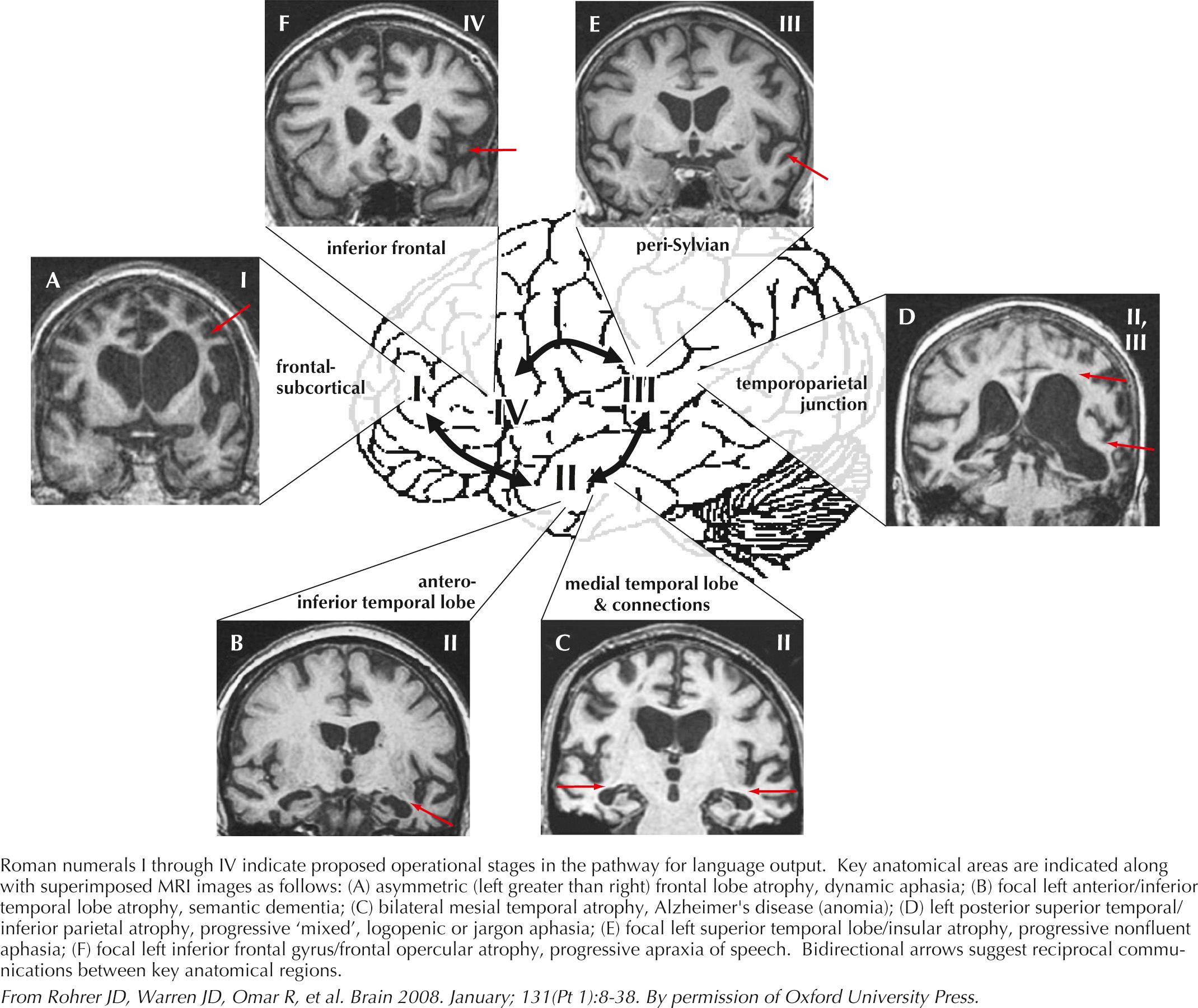 Fig. 25.4, Structural Anatomy of Word-Finding Difficulty in Degenerative Disorders.