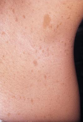 FIGURE 40-2, A café-au-lait spot and multiple freckles (Crowe’s sign) in the axillary vault is seen in this patient with neurofibromatosis.