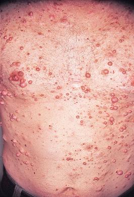 FIGURE 40-3, Multiple neurofibromas are present in this individual.