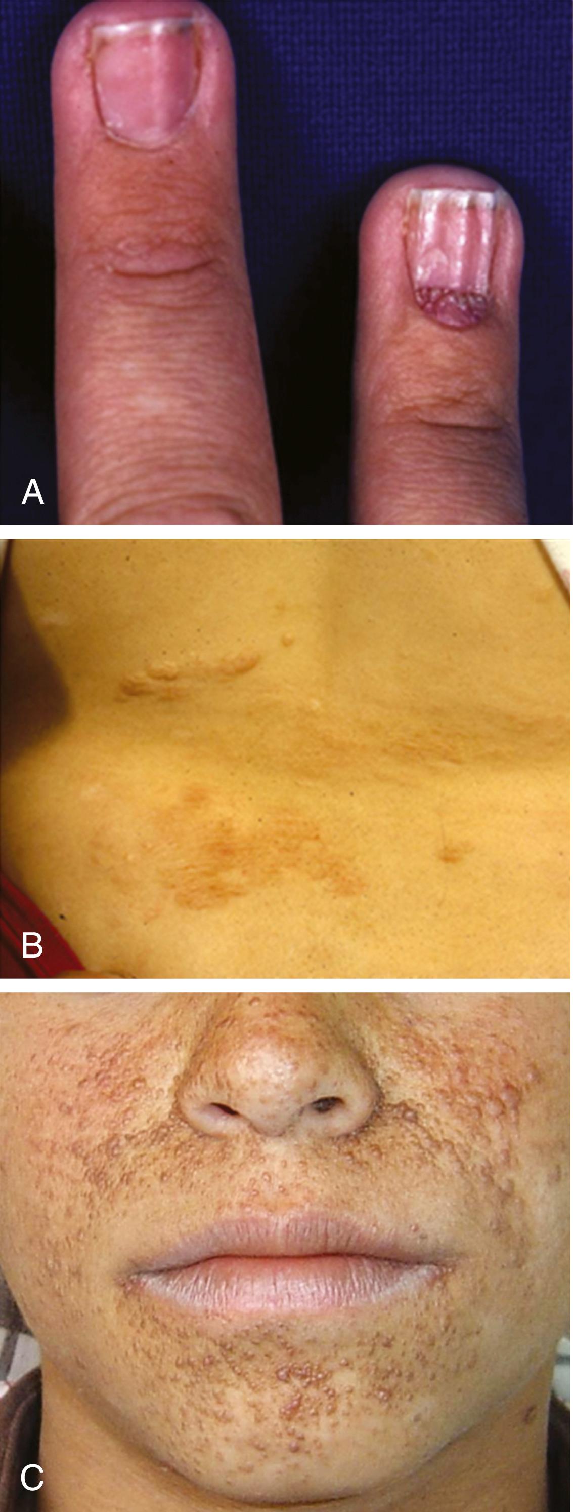 Fig. 99.1, Classic cutaneous manifestations of tuberous sclerosis include ( A ) ungual fibromas, ( B ) shagreen patch on the lower back, and ( C ) facial angiofibromas.