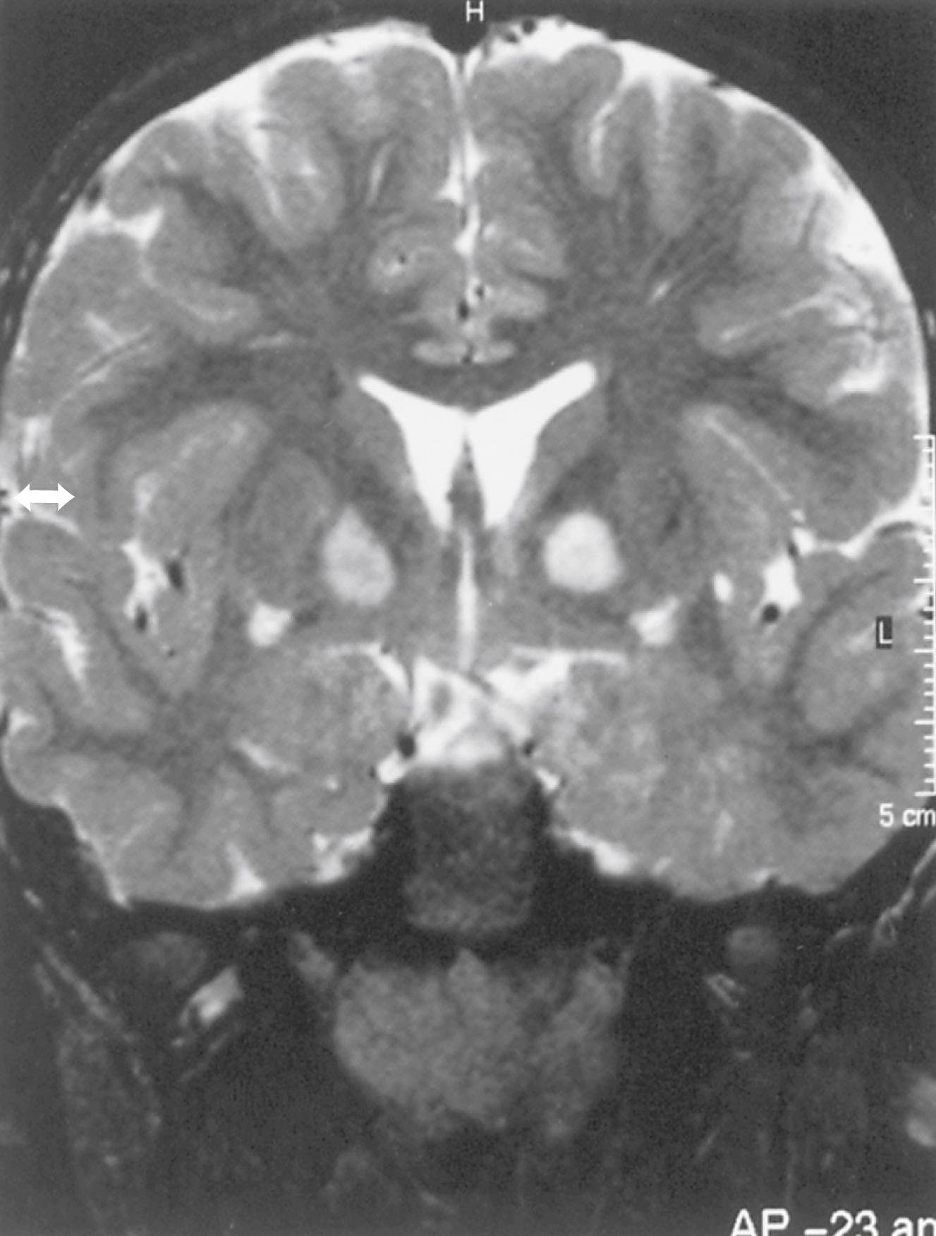 Fig. 99.11, Coronal T2-weighted magnetic resonance imaging scan shows bilateral high-signal lesions in the basal ganglia, abnormalities typical of neurofibromatosis type 1.