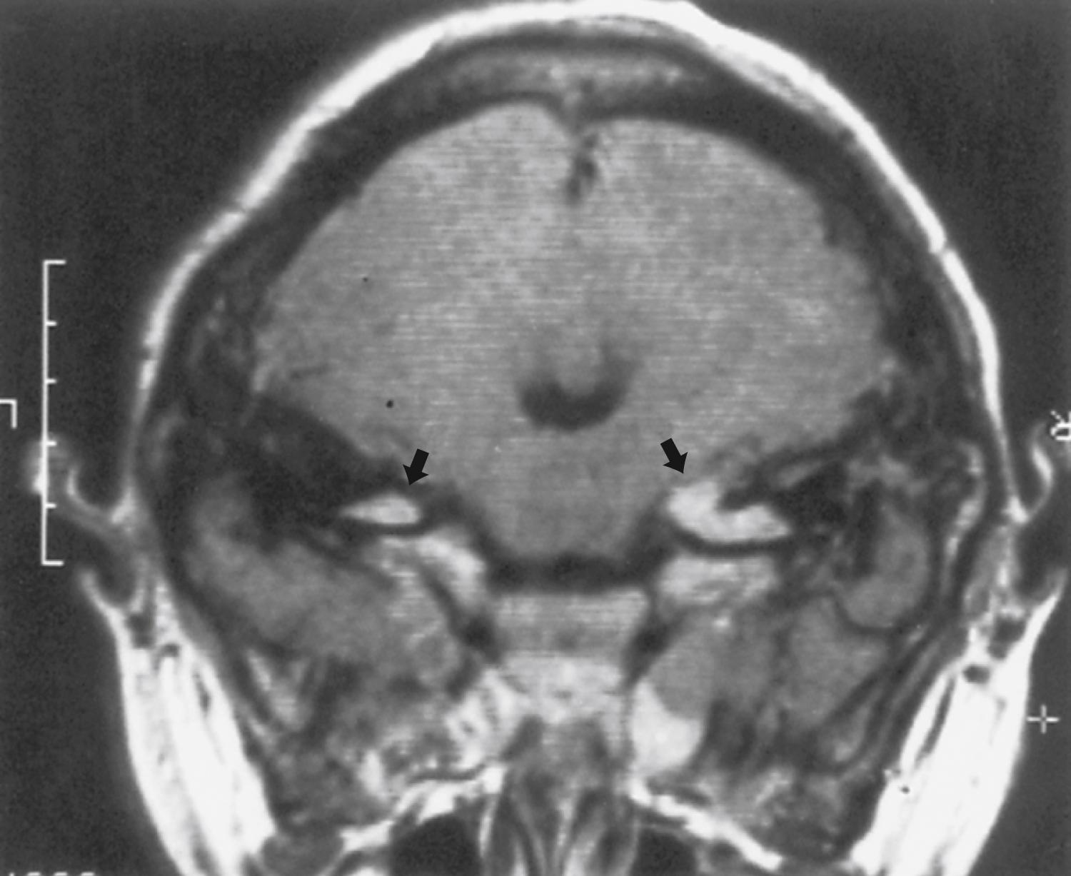Fig. 99.13, Cranial magnetic resonance imaging scan from a child with neurofibromatosis type 2 shows bilateral vestibular tumors (arrows) . As these grow larger, there is an increased likelihood of symptoms.