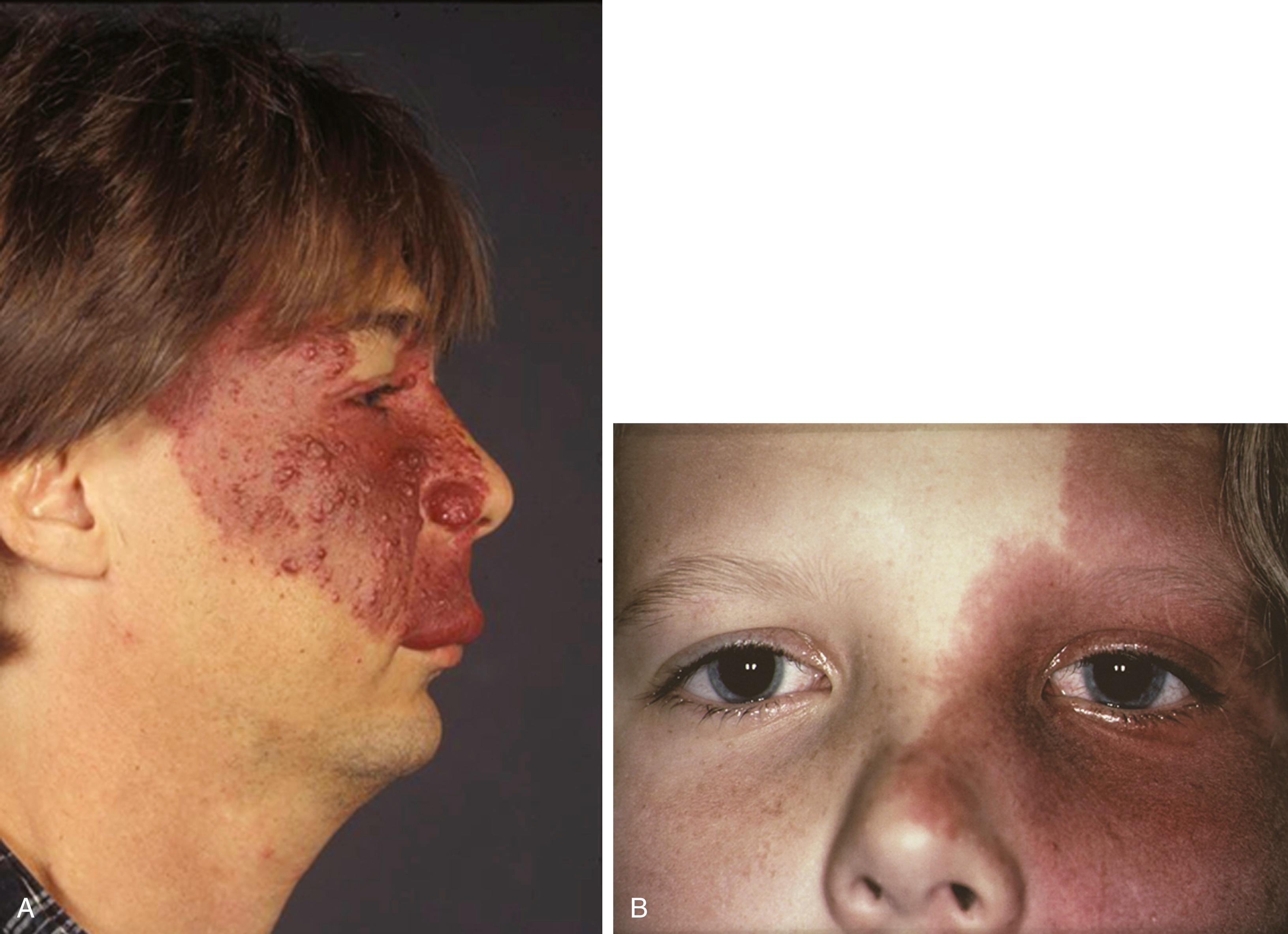 Fig. 99.14, Two patients with the classic distribution of the port-wine nevus of Sturge-Weber syndrome on the face and eyelid. A, The nevus has developed a nodular texture. B, Episcleral or conjunctival angiomas can occur on the affected side.