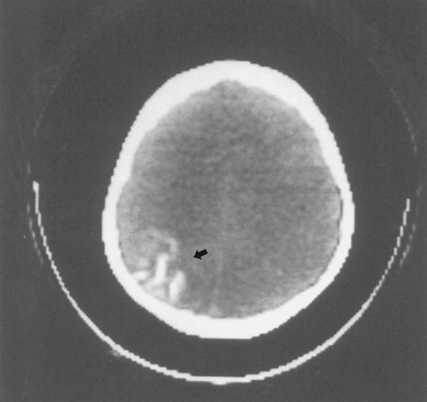 Fig. 99.15, Computed tomographic scan from a typical patient with Sturge-Weber syndrome; the occipital gyriform calcification pattern (arrow) is easily seen.