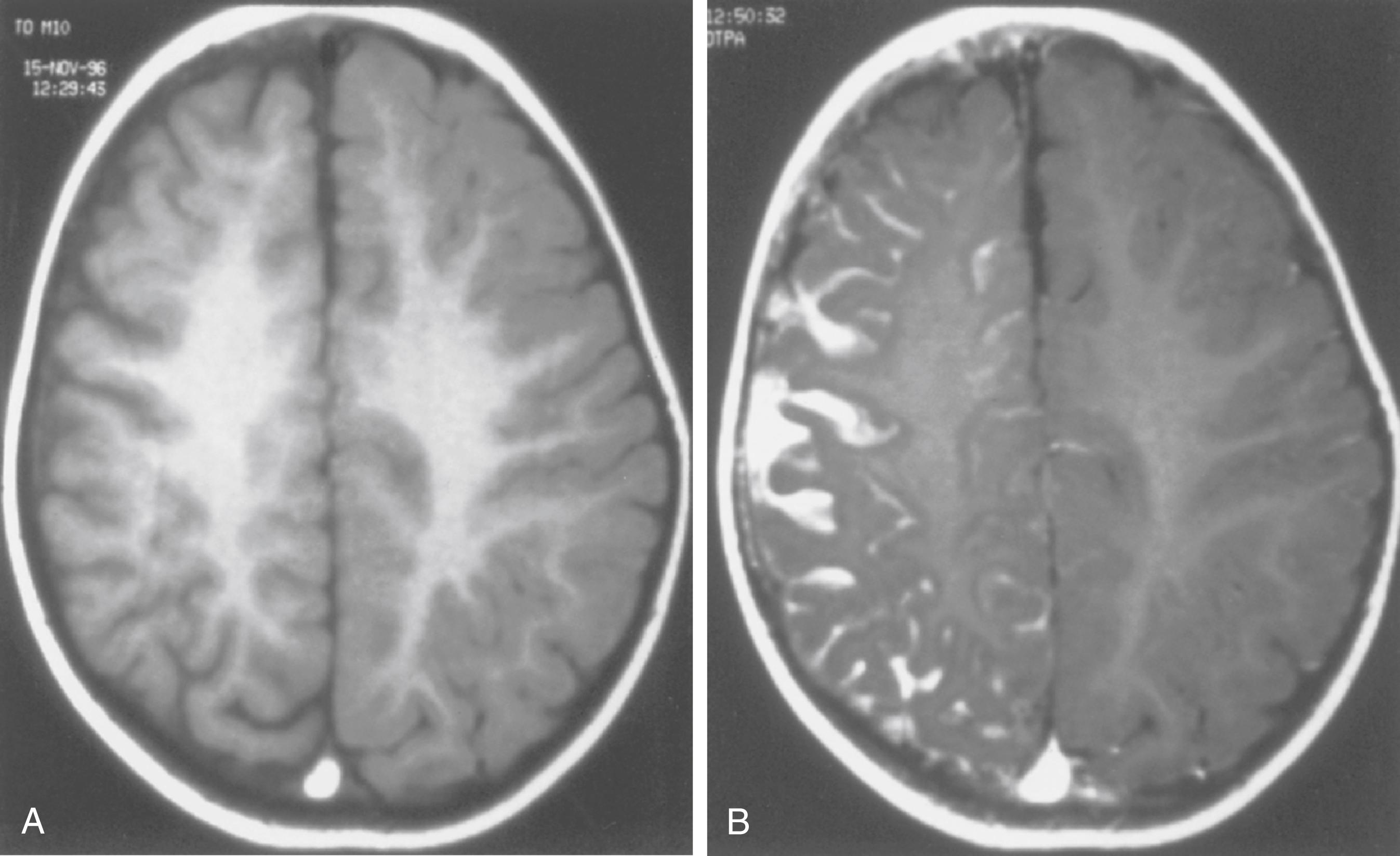 Fig. 99.16, A, Magnetic resonance imaging study from a child with Sturge-Weber syndrome; this T1-weighted axial view without contrast infusion is normal. B, Scan on the same child with gadolinium reveals leptomeningeal and intraparenchymal angioma.