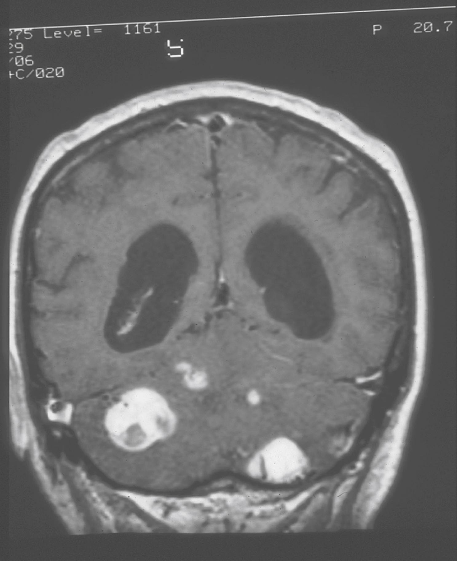 Fig. 99.17, Magnetic resonance imaging showing multiple cerebellar hemangioblastomas in a patient with Von Hippel-Lindau syndrome.