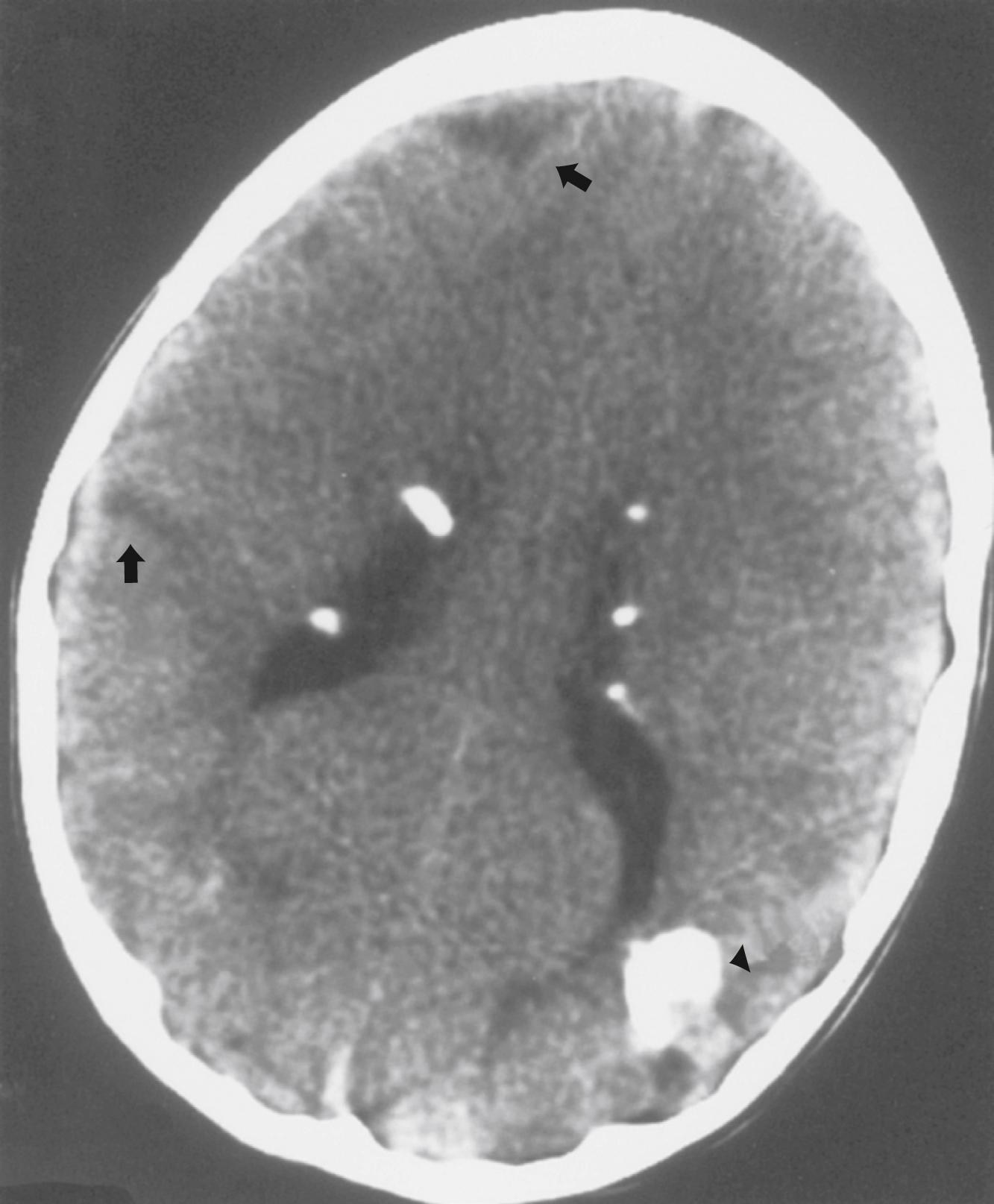 Fig. 99.3, Computed cranial tomography scan from a child with tuberous sclerosis complex demonstrates typical calcified subependymal nodules; a large calcified parenchymal lesion (arrowhead) and low-density cortical lesions (arrows) are seen as well.