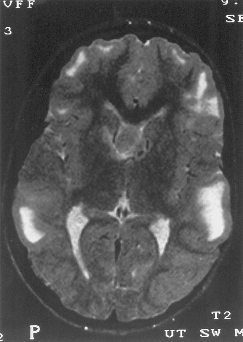 Fig. 99.4, Noncontrast T2-weighted magnetic resonance imaging scan from a child with tuberous sclerosis demonstrates extensive high-signal cortical lesions typical of tuberous sclerosis.