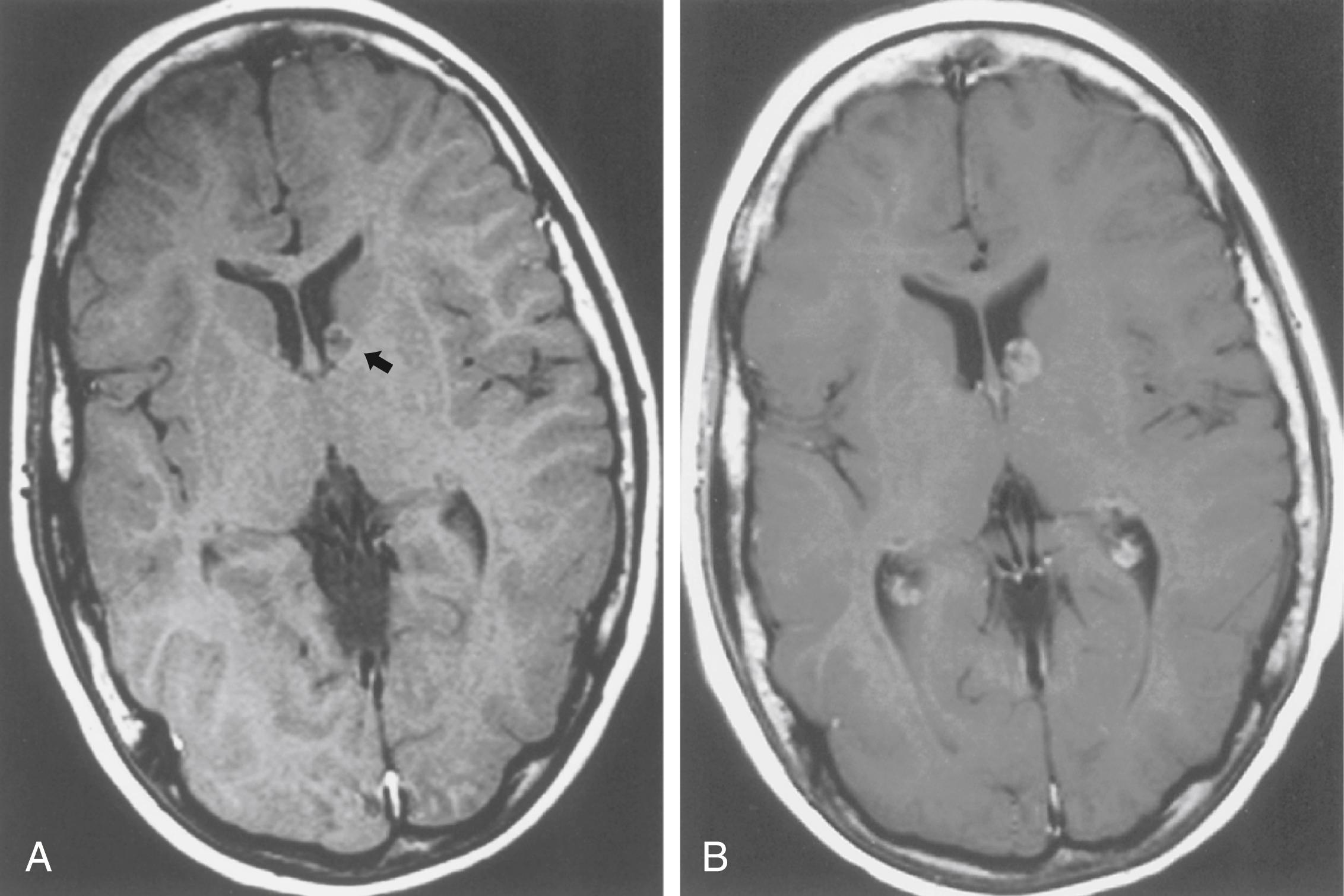 Fig. 99.5, A, Noncontrast T1-weighted magnetic resonance imaging scan from a child with tuberous sclerosis shows an irregular mass (arrow) with a central signal void caused by calcification protruding into the left frontal horn. B, Another scan with gadolinium a few months later shows contrast enhancement and minimal tumor growth.