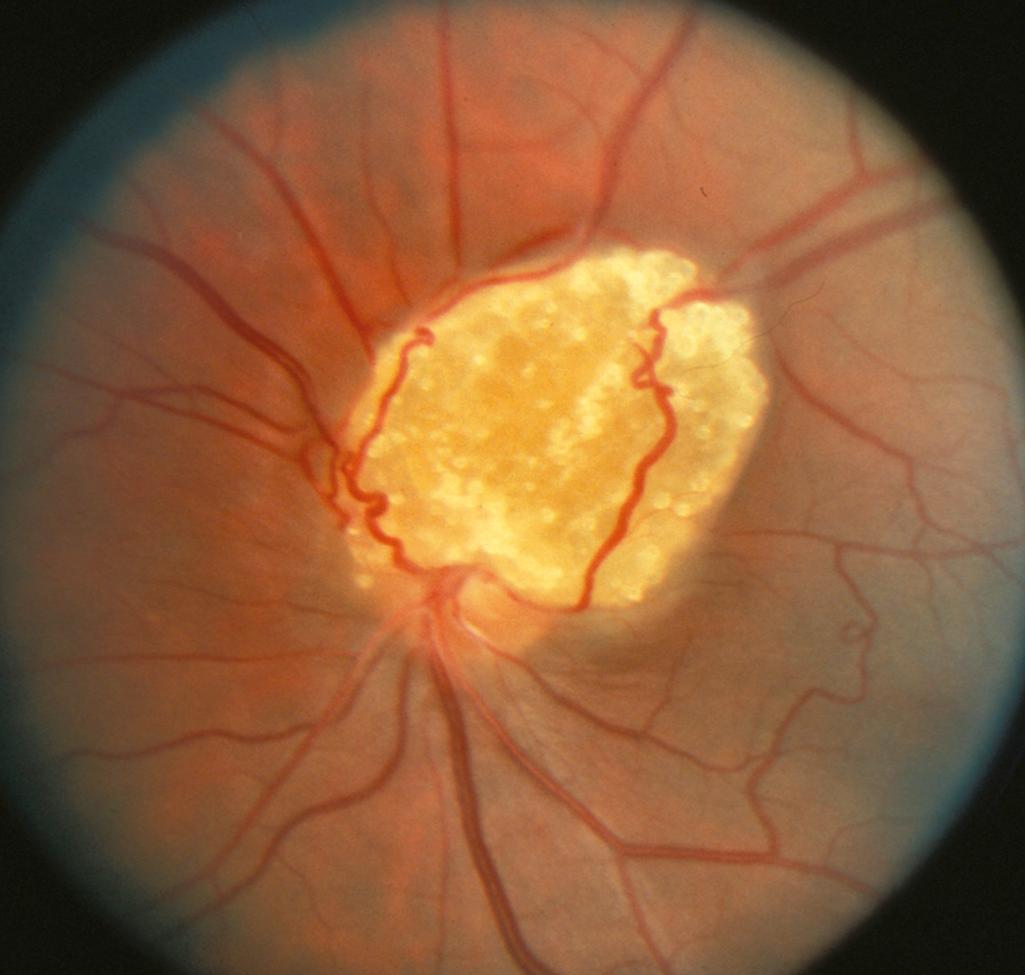 Fig. 99.6, A retinal astrocytoma (mulberry lesion) adjacent to the optic nerve is typical of those found in tuberous sclerosis.