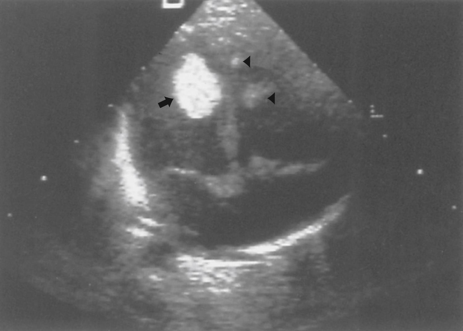 Fig. 99.7, Prenatal ultrasound study reveals a large cardiac rhabdomyoma (arrow) and two smaller rhabdomyomas (arrowheads) in a child who subsequently proved to have tuberous sclerosis.