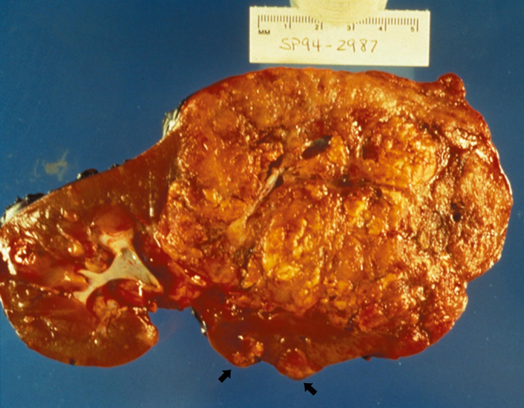 Fig. 99.8, A large angiomyolipoma of the lower pole of a kidney removed at surgery; several smaller angiomyolipomas (arrows) can be seen in the same specimen.