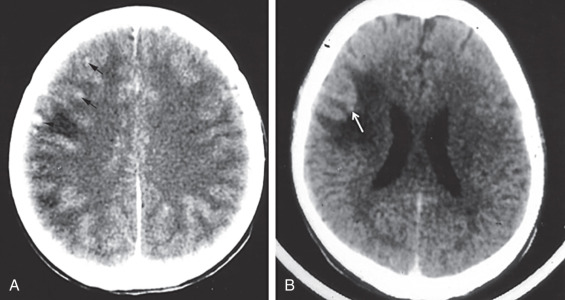Figure 9.2, Noncystic stage of parenchymal cysticercosis. (A) A 9-year-old male with history of seizures: contrast-enhanced computed tomography (CT) scan shows multiple enhancing nodules at gray-white matter junctions (arrows) ; one is associated with surrounding parenchymal edema. (B) A 37-year-old female with left-upper-extremity numbness and headaches: contrast-enhanced CT reveals a small enhancing nodule (arrow) surrounded by vasogenic edema. Months later, multiple small cysticercus cysts developed within the brain parenchyma (not shown).