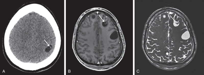 Figure 9.3, Vesicular stage of neurocysticercosis (NCC). (A) Axial contrast-enhanced computed tomography, (B) postcontrast T1 magnetic resonance imaging (MRI), and (C) constructive interference in steady state (CISS) MRI demonstrate fluid-filled cysts without wall enhancement or surrounding parenchymal edema. Eccentric intracystic nodules (arrows) represent the scolices. Cysticerci within the brain parenchyma are usually small and tend to occur at gray-white matter junctions or within the deep gray matter. These cysts rarely measure more than 10 mm, likely related to surrounding intraparenchymal pressure, which prevents further cyst expansion. The scolex is best seen on the CISS sequence; when visualized it is diagnostic for NCC.