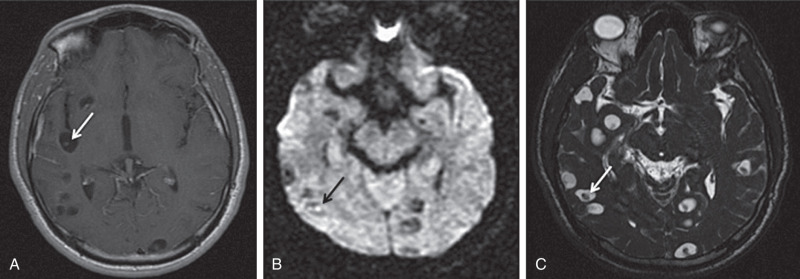 Figure 9.4, Magnetic resonance imaging of vesicular stage of neurocysticercosis (NCC). (A) Axial postcontrast T1 image demonstrates multiple nonenhancing cysts, each containing a scolex (arrow) . (B) Axial diffusion-weighted imaging (DWI) demonstrates eccentric foci with diffusion restriction, each corresponding to a scolex (arrow) . (C) Axial constructive interference in steady state demonstrates multiple thin-walled cysts, each containing a clearly delineated eccentric scolex (arrow) . The fluid within the cyst is similar to cerebrospinal fluid signal on all sequences, including FLAIR (not included). The intracystic fluid is not restricted on DWI, which differentiates this lesion from a pyogenic abscess. These findings are diagnostic of the vesicular stage of NCC.