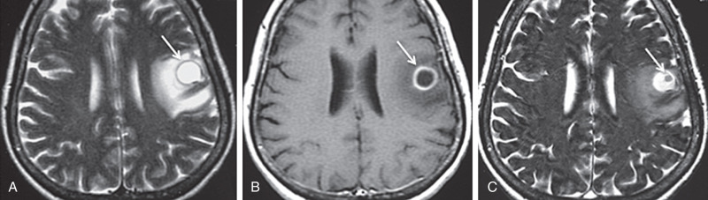 Figure 9.5, Magnetic resonance imaging of colloidal vesicular stage. (A) Axial T2 image demonstrates a cyst with surrounding vasogenic edema in the left frontal lobe (arrow) . (B) Axial postcontrast T1 image demonstrates cyst wall enhancement. (C) Axial constructive interference in steady state (CISS) image demonstrates an eccentric intracystic nodule corresponding to the scolex. The scolex is not as apparent on T2 due to its intrinsic hyperintense signal but is well seen on CISS, typically as a hypointense nodule. FLAIR (not included) may show fluid isointense to cerebrospinal fluid in the early colloidal vesicular stage, although hyperintense fluid signal develops in the late colloidal vesicular stage. The scolex may be present in the early phase (as in this case), but it disappears by the end of the colloidal vesicular stage (see Fig. 9.7 ).