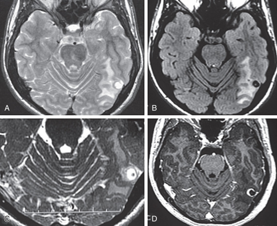 Figure 9.6, Magnetic resonance imaging of early colloid vesicular stage. (A) Axial T2, (B) FLAIR, and (C) constructive interference in steady state (CISS) images demonstrate perilesional edema. (D) A postcontrast T1 image demonstrates cyst wall enhancement. The scolex is still present but not seen on T2 images because it is isointense in signal to cerebrospinal fluid. At this early colloidal vesicular stage, the cyst fluid is not yet turbid on FLAIR or T1 images, but wall enhancement and perilesional edema, the essential findings of this stage, are present. The scolex is still seen on FLAIR and CISS sequences; this is also suggestive of the early colloidal vesicular stage.