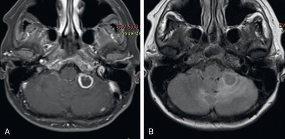 Figure 9.7, Magnetic resonance imaging of late colloidal vesicular stage. (A) Axial T1 postcontrast and (B) FLAIR images demonstrate a cystic lesion with wall-enhancement and surrounding parenchymal edema. The intracystic fluid is turbid (hyperintense to cerebrospinal fluid) on both T1 and FLAIR images. An intracystic scolex cannot be seen. These are typical features of the late colloidal vesicular stage. These findings are indistinguishable from those of primary or metastatic tumor or of other less common ring-enhancing lesions. However, they are not typical of abscess because there is no internal fluid diffusion restriction on diffusion-weighted imaging (not included).