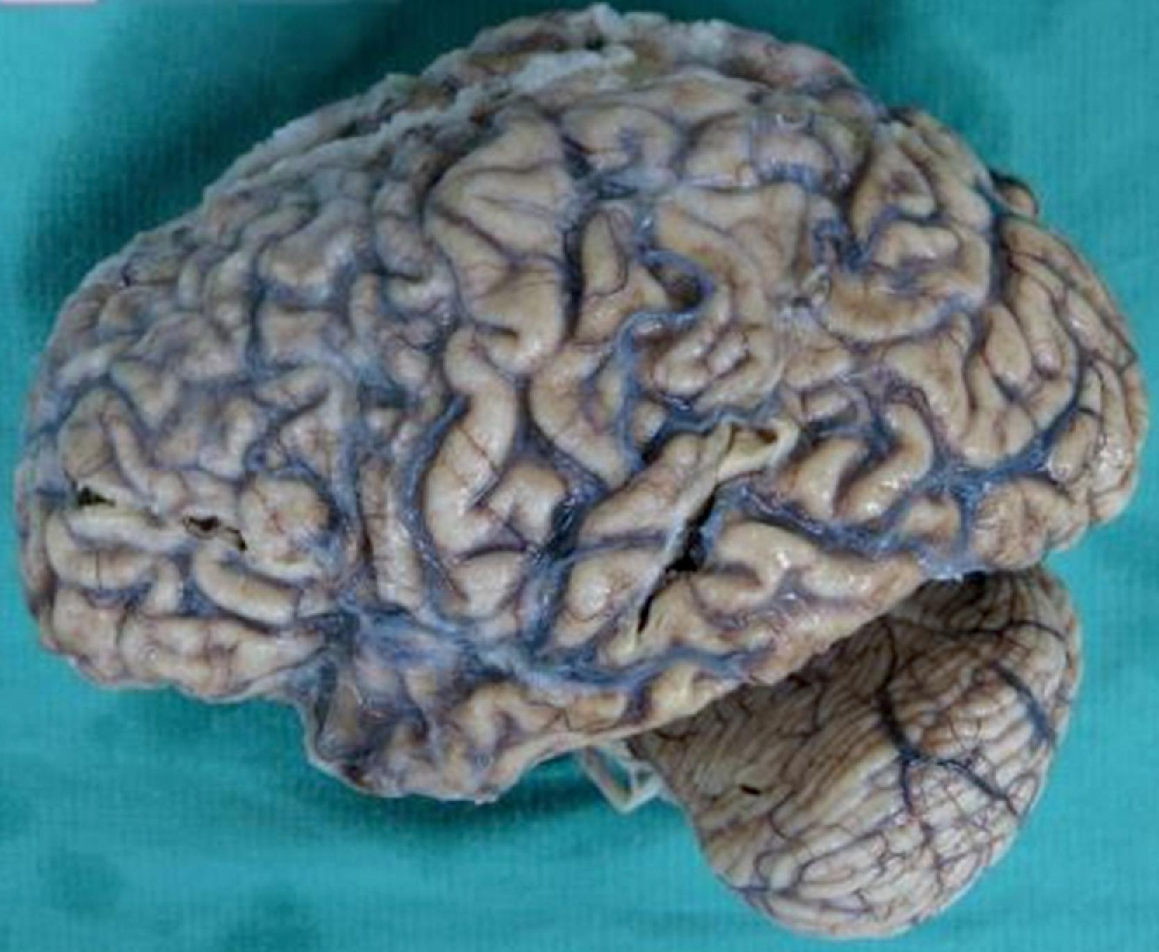 Figure 6.1, Typical gross appearance of the brain in Alzheimer disease, with diffuse cerebral atrophy (above) and moderate to severe dilatation of the ventricular system (not shown).