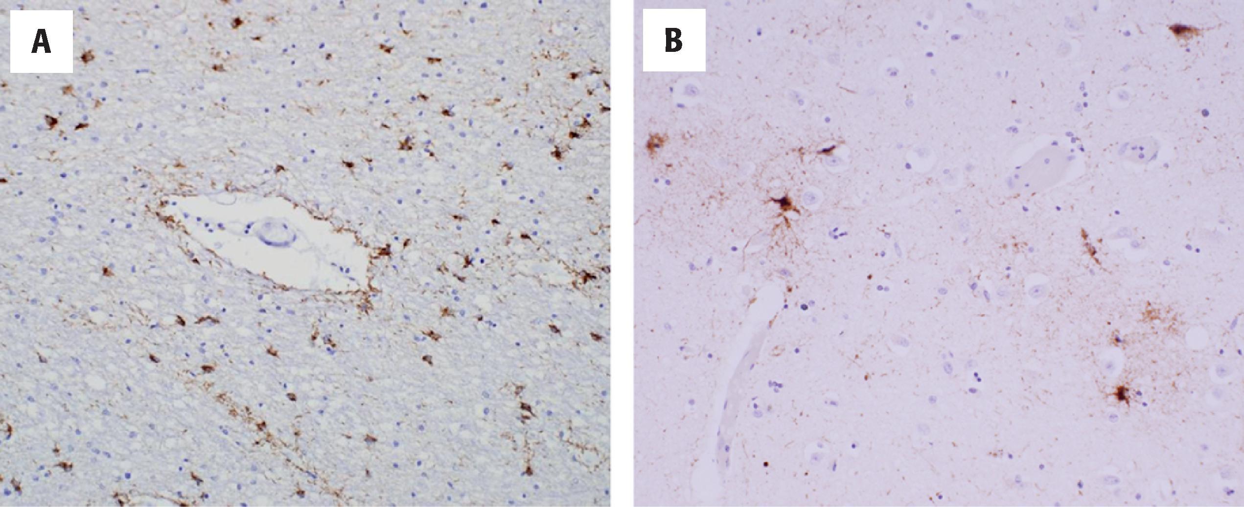 Figure 6.12, Aging-related tau astrogliopathy (ARTAG) is detected by phospho-tau (AT8) immunostain, as shown here. Various forms of ARTAG include thorn-shaped astrocytes in white matter and around blood vessels (A), as well as gray matter ARTAG, shown here with granular or fuzzy astrocytes in the amygdala (B) of an elderly patient without significant neuronal tau pathology.