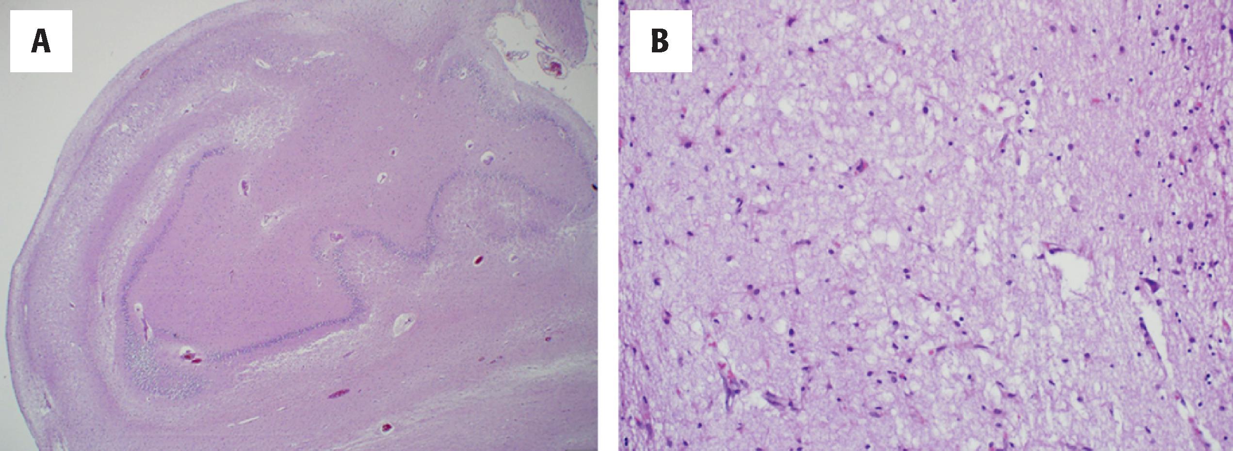 Figure 6.13, Patients with limbic-predominant age-related TDP-43 encephalopathy–neuropathologic change (LATE-NC) may have hippocampal sclerosis, with marked hippocampal atrophy and massive neuronal loss (A) in sector CA1 (B) and subiculum. H&E staining is shown.