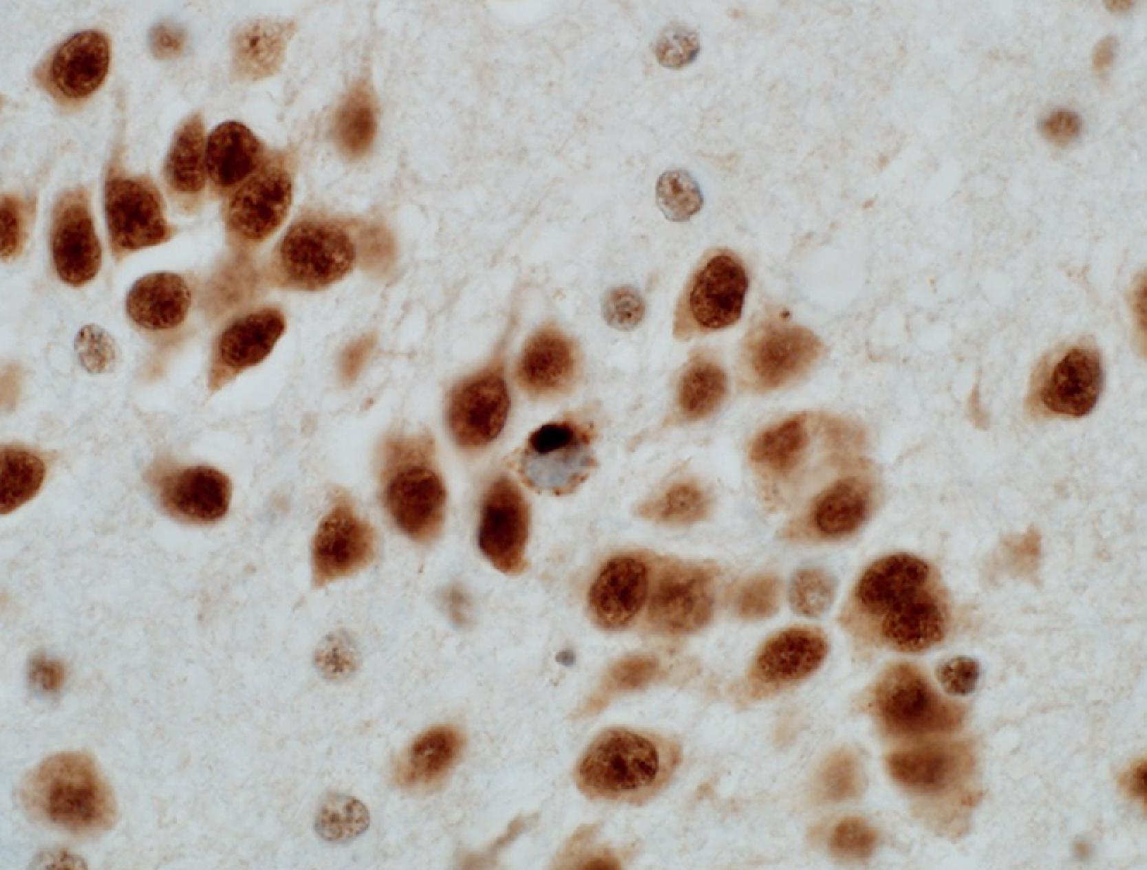 Figure 6.14, Limbic-predominant age-related TDP-43 encephalopathy–neuropathologic change is characterized by pathologic inclusions of TDP-43, as shown here in the dentate gyrus of the hippocampal formation. Shown is an N-terminal/full-length TDP-43 immunostain and pathologic staining is shown in the neuron at center, with loss of nuclear staining and dense cytoplasmic staining.