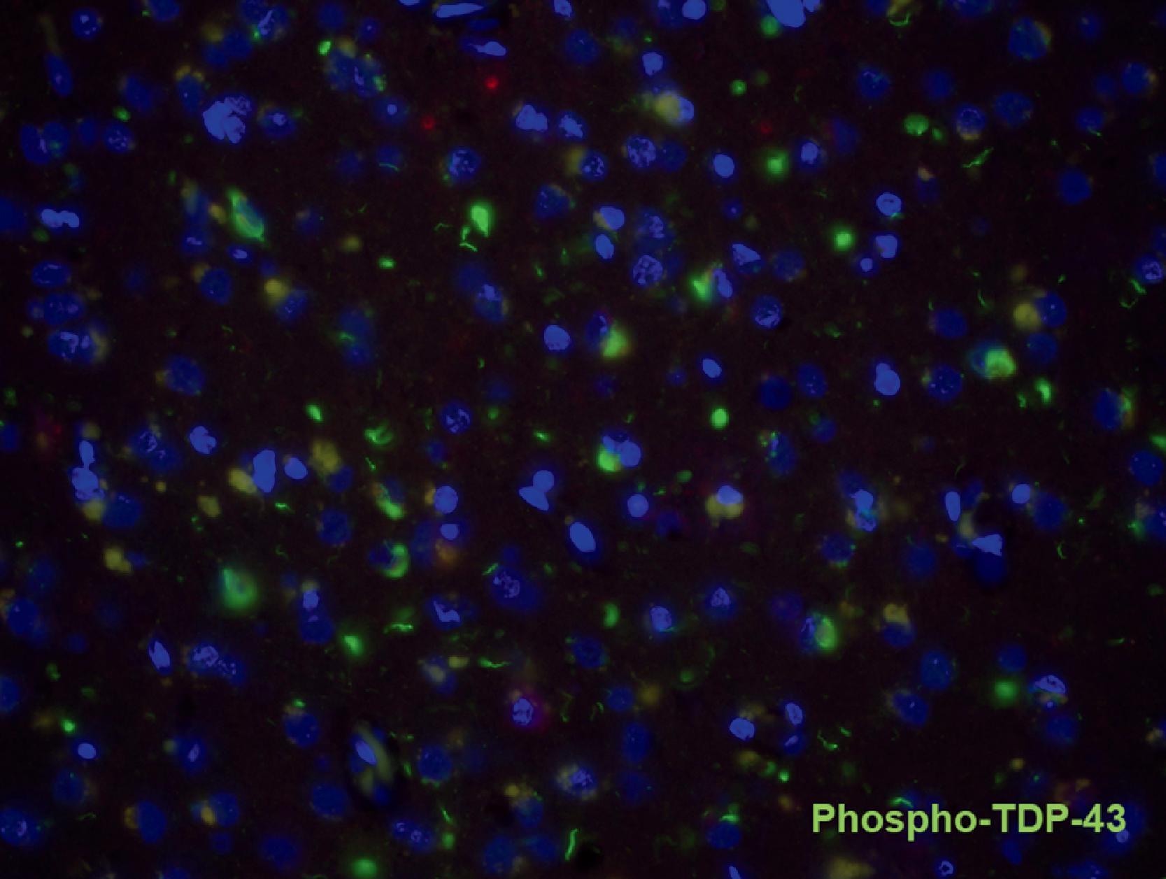 Figure 6.15, Cases with limbic-predominant age-related TDP-43 encephalopathy–neuropathologic change can have frontotemporal lobar degeneration type A-like pathology on TDP-43 staining, with numerous short neurites and neuronal cytoplasmic inclusions in the lamina II of the limbic cortex. This is an immunofluorescence preparation of transentorhinal cortex using phospho-TDP-43.