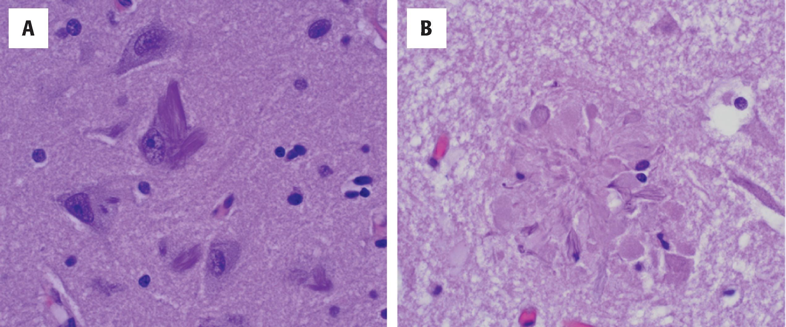 Figure 6.2, H&E staining shows characteristic Alzheimer disease pathologies, including basophilic, flame-shaped neurofibrillary tangles (A) and amyloid plaques (B).