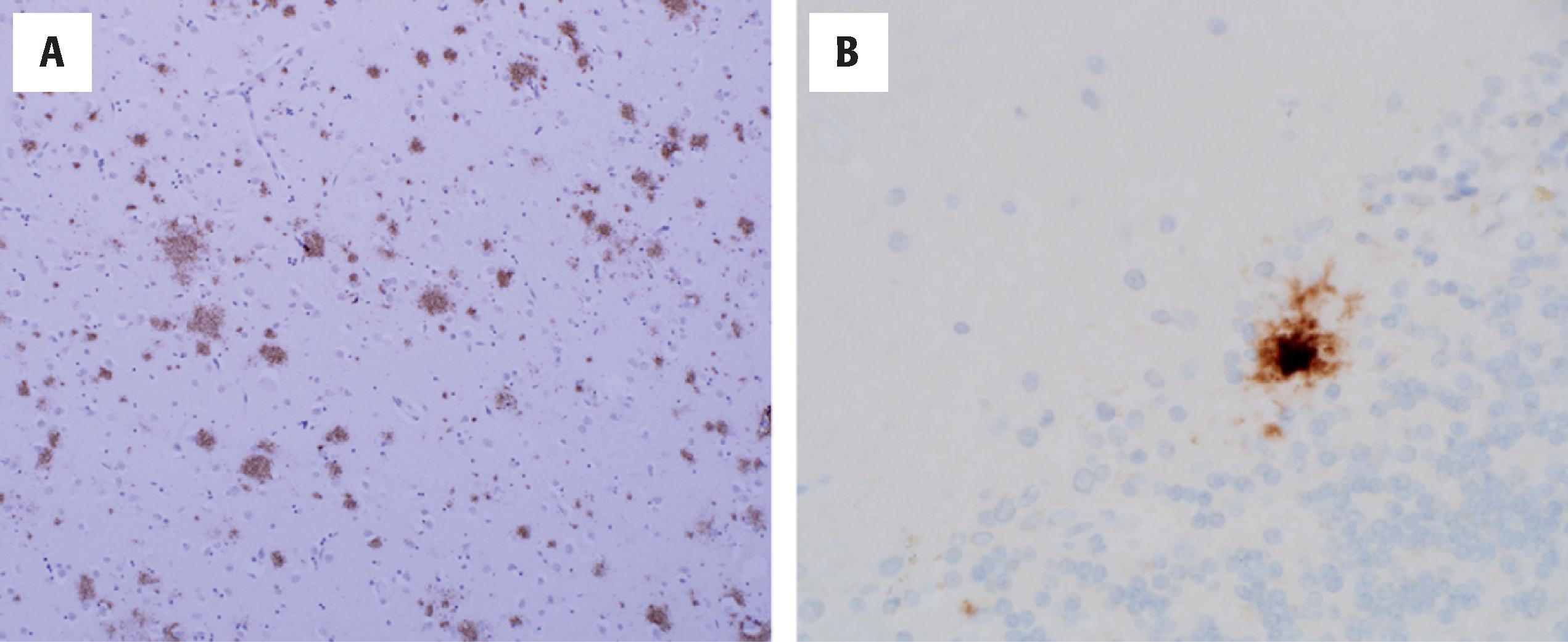 Figure 6.3, Aβ immunostains are useful in detecting non-neuritic/diffuse plaques, as shown here in two different patients with plaque pathology in the striatum (Thal phase 3) (A) and cerebellum (Thal phase 5) (B).